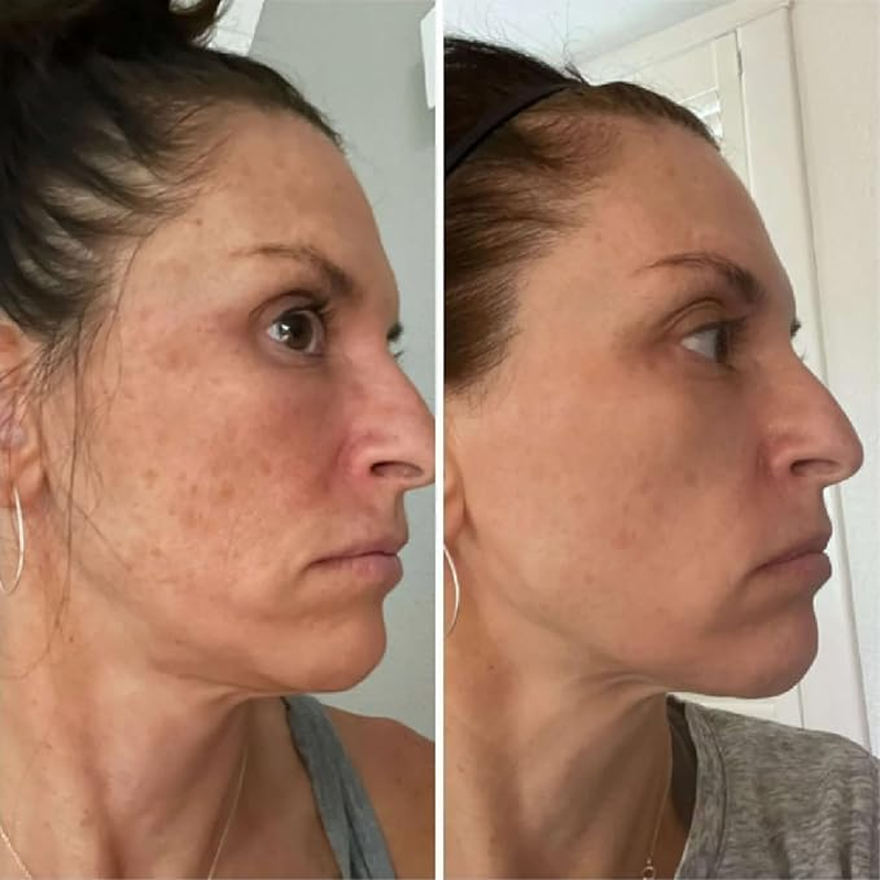 Tcatherapycare Gel Peel 60% (Professional Skin Peel) - (Level 2 Ph 1.9) - Exfoliating Face Peel &ndash; 1 Fl Oz/30Ml image number 2