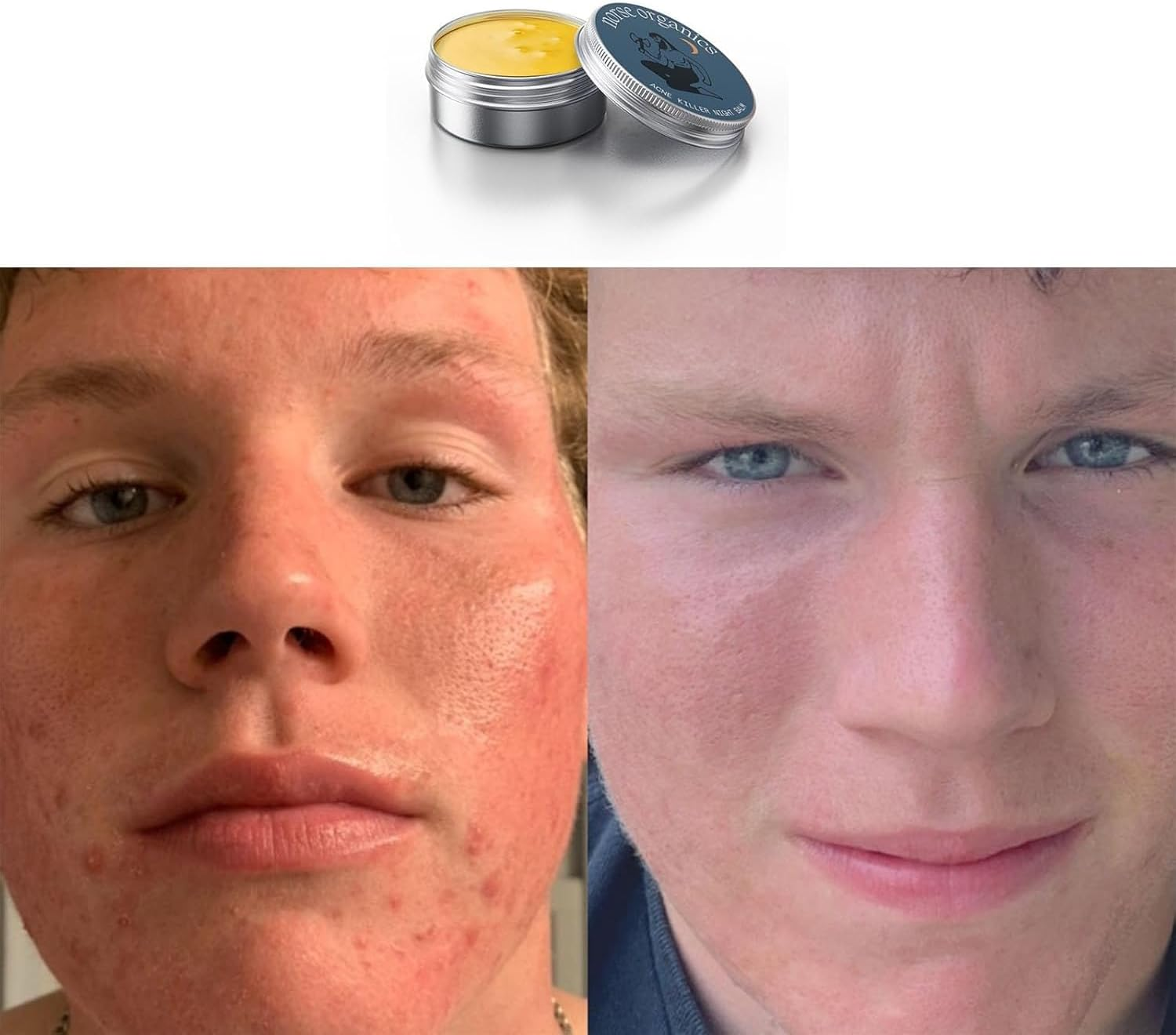 Norse Organics Acne & Redness Killer, Norse Organics Acne Balm, Acne Remove Skin Care Set, Ultra-Performance Skincare,1 Pcs