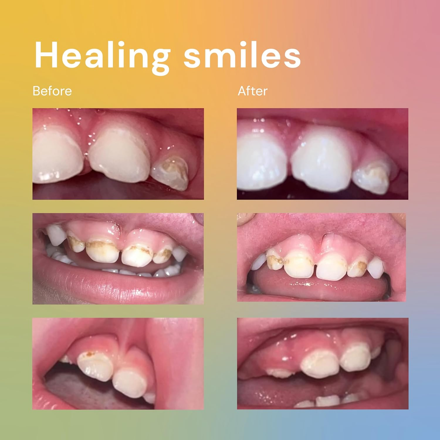 Bliss Energetics Remineralizing Tooth Puddy | Fluoride-Free with Hydroxyapatite | Remineralization | All Natural Ingredients & Preservative Free | Mineral-Rich Spot Treatment 2Oz (1 Ounce (Pack of 1))