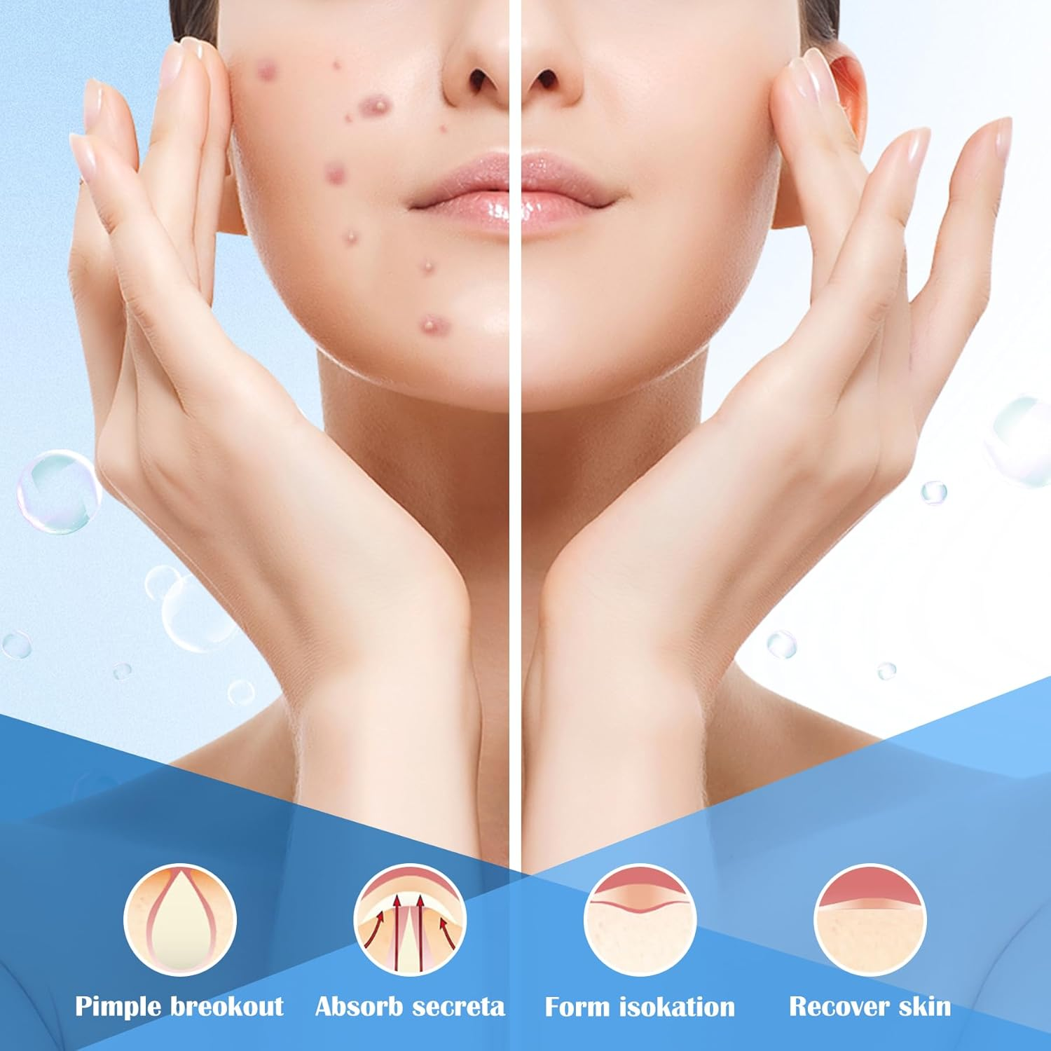 EKIND 180PCS Pimple Patches, Hydrocolloid Acne Patches for Face, Invisible Spot Cover for Blemishes & Breakouts, 2 Size Zit Patches image number 5