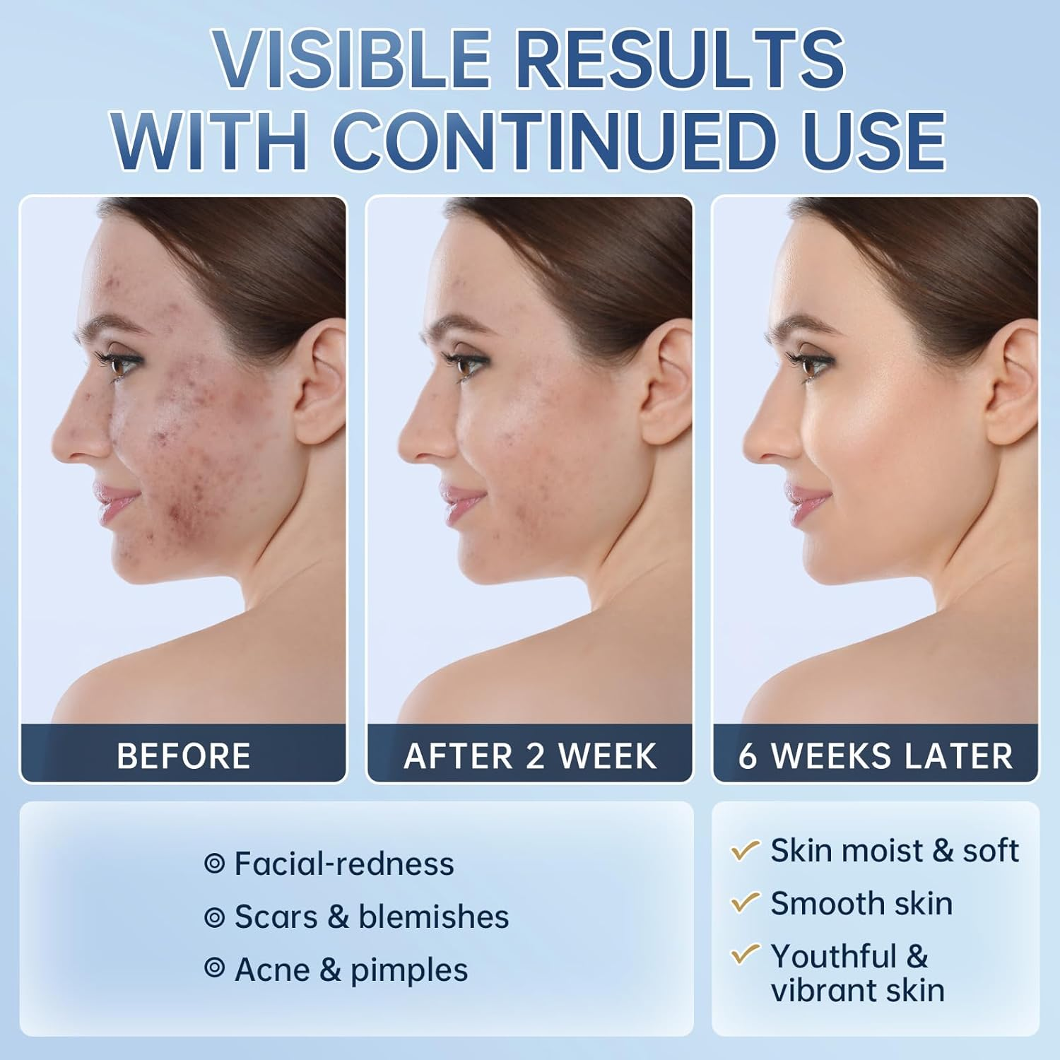 Azelaic Acid Face Serum Cream for Redness Relief,Dark Spots,Azelaic Acid Acne Cream with Niacinamide & Vitamin C,Acid 14% Facial Serum Balance Excess Sebum & Soothe Irritation,30Ml image number 2