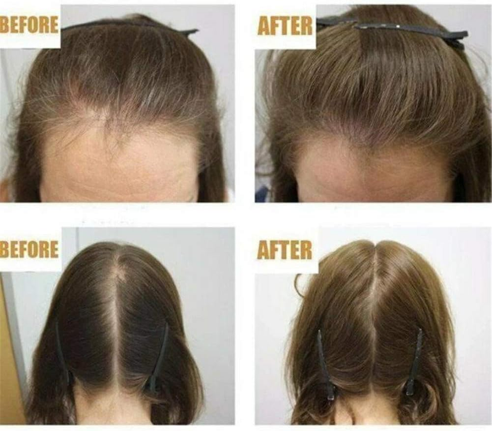 Hair Regrowth Serum-Hair Growth Essence Oil, Hair Growth Treatment, Stops Hair Loss, Thinning,Balding, Promotes Thicker, Fuller and Faster Growing Hair