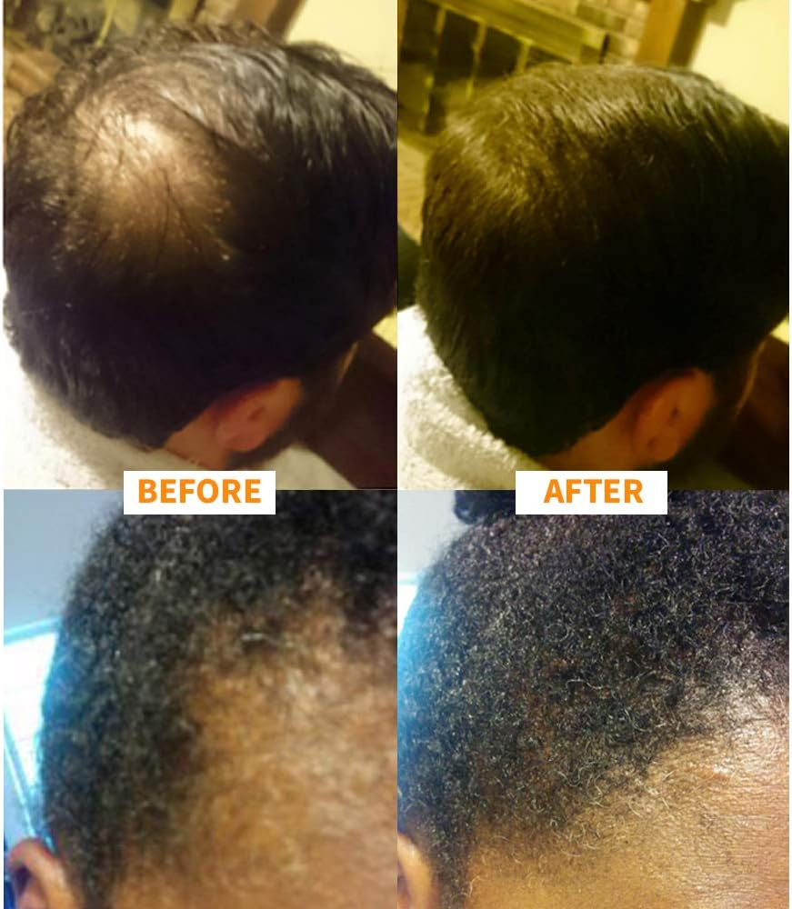 Nor1 Keratin Hair Building Fibers: Hair Fiber Filler and Thickener for Men and Women - Cover up and Concealer for Thinning Areas or Minor Bald Spot - Thicker, Fuller Hair in Seconds - 25 Grams