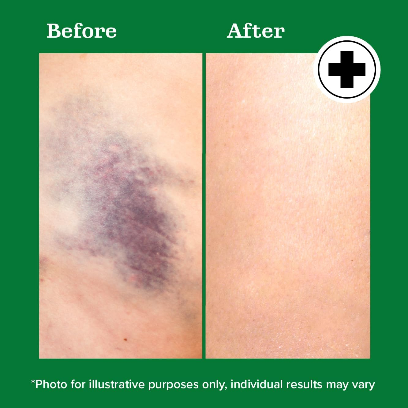 Miracle plus Natural Arnica Bruise Body Gel | Arnica Montana Lotion for Thin Skin Bruising and Swelling after Surgery | Extra Strength Vitamin K Cream | Skin Care Arnica Ointment for Bruises, 4 Oz image number 6