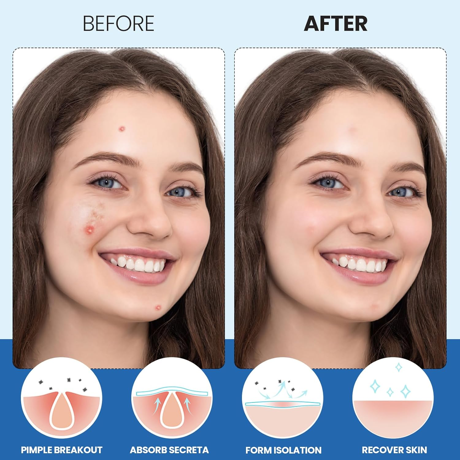 240 Counts Pimple Patches for Face, Hydrocolloid Acne Patches Pimple Patch Invisible Pimple Patch Zit Patches for Face Acne Patch Blemish Patches Zit Stickers for Skin Care image number 2