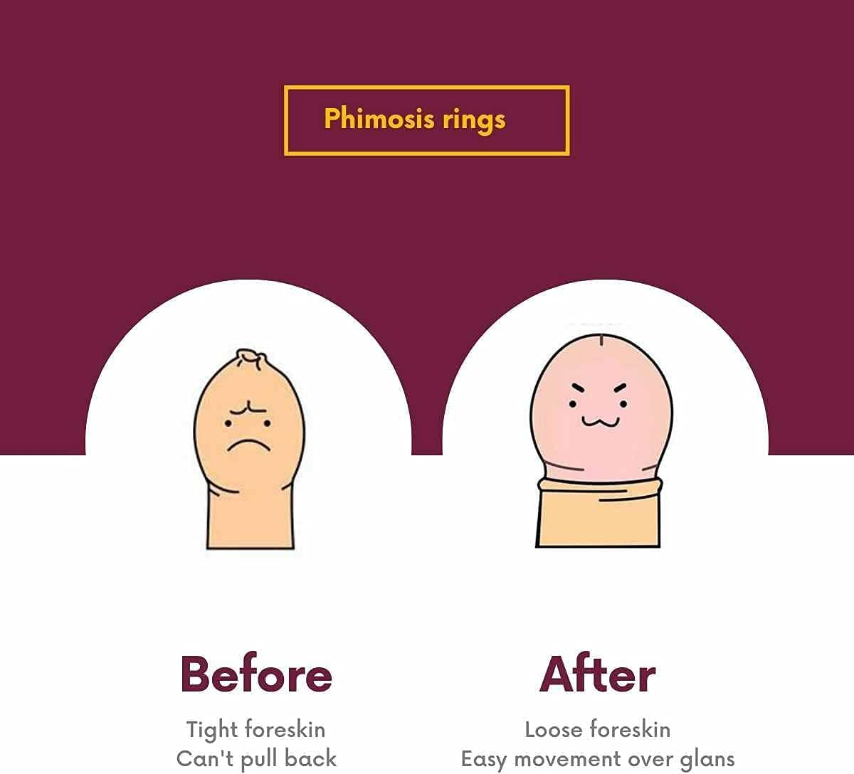 Vajraang Phimosis Stretching Rings (20 Rings Set) with Applicator Tool and 'How to Use' Booklet image number 5