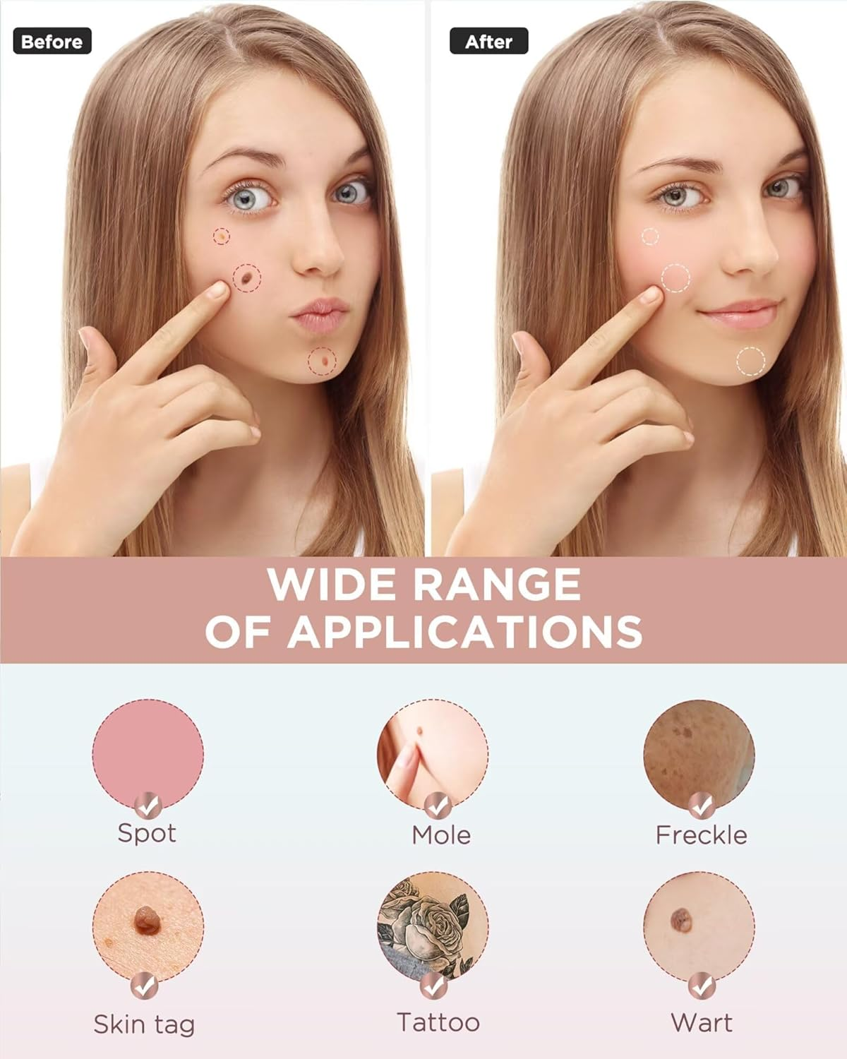 Skin Tag Remover - for Home Use, Portable Removal Kit for Mole, Wart and Skin Tag for Women and Girls, Fast Acting, Safe and Easy to Use image number 2