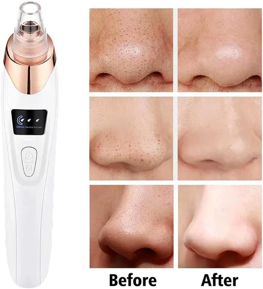 Annuoyi Blackhead Remover Vacuum, with 5 Detachable Facial Cleaning Suction Heads, USB Rechargeable Acne Removal Vacuum Kit, Suitable for Female and Male Facial Skin(White) image number 1