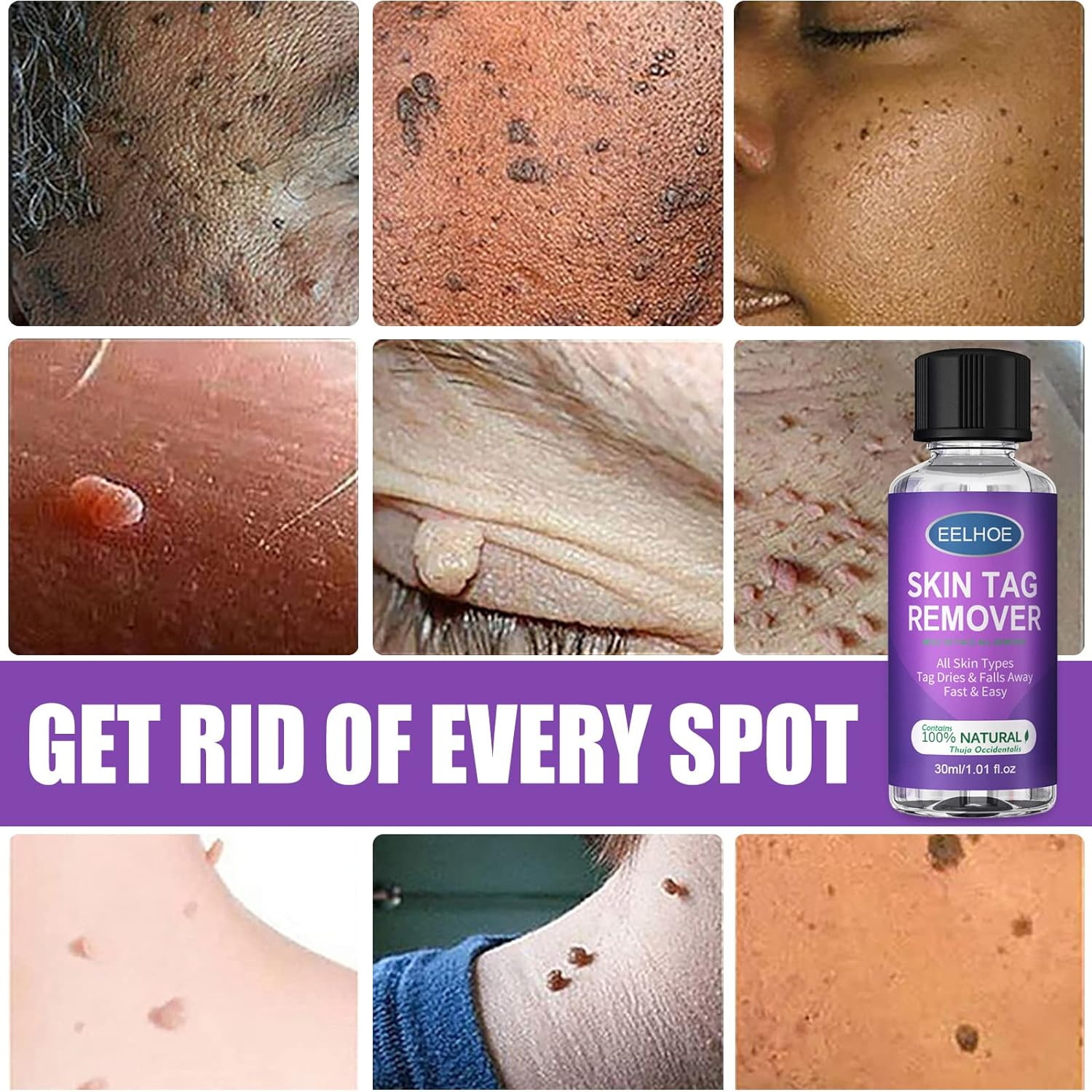 Skin Tag Remover - Professional Grade Fast Acting Liquid for Skin Tags, Moles & Warts Removal - Painless Treatment for Face & Body - 30Ml Easy Application Bottle image number 4