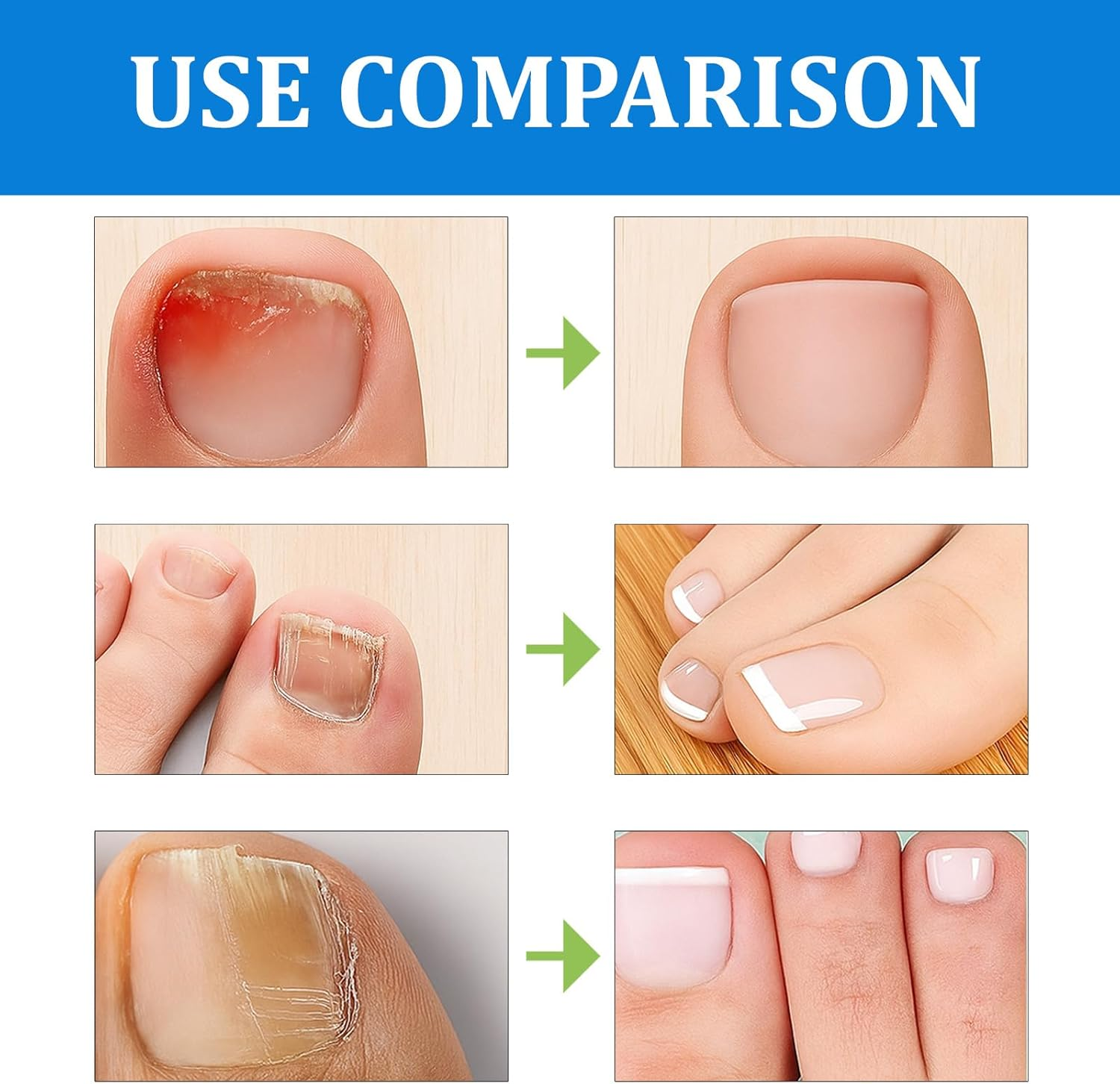 32 Pcs Fungal Nail Patches, Overnight Nail Repair Patches for Long-Term Fungal Toenail Treatment, Toenail Fungus Treatment for Healthy-Looking Nails image number 6