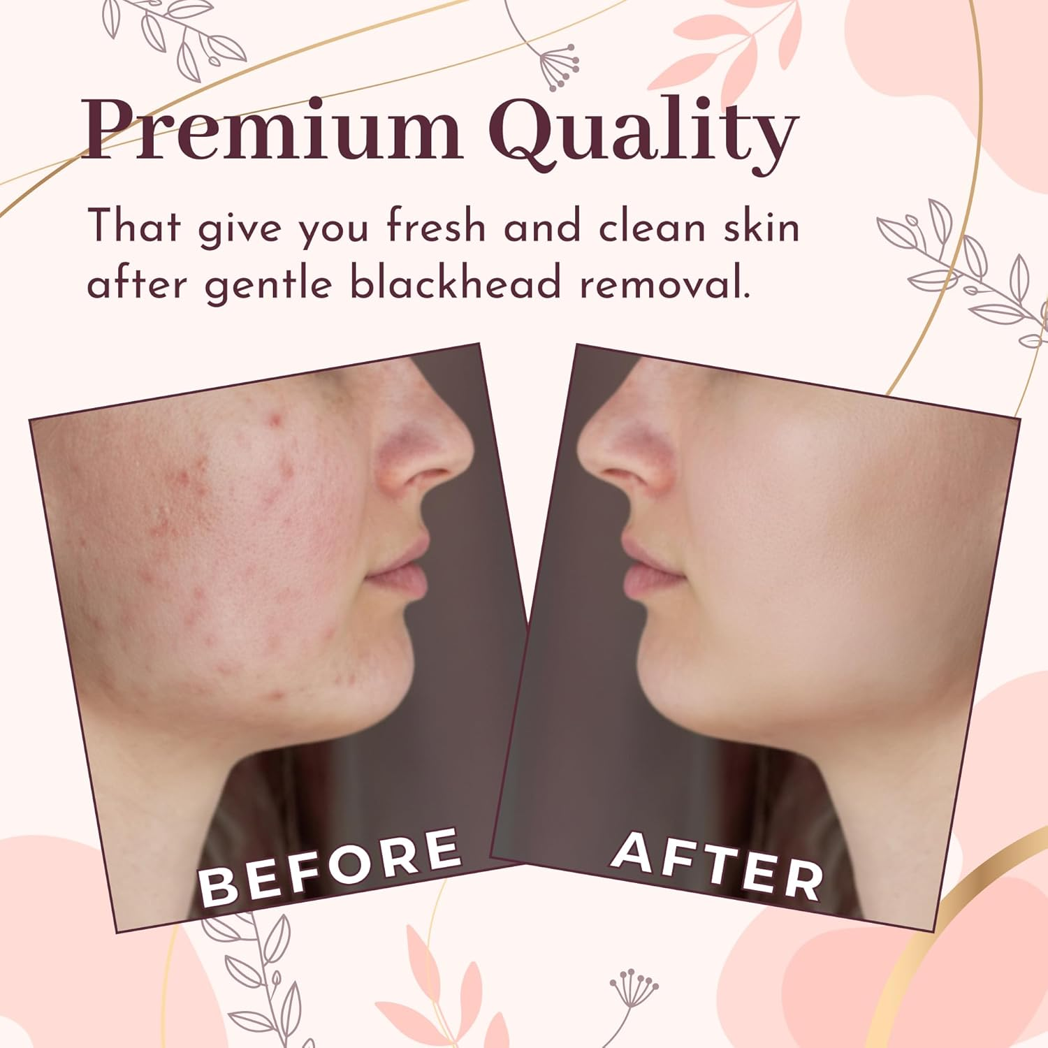 Blackhead Remover Professional Skincare Spot Treatment Blackhead Remover Tool for Blemish Comedone Whiteheads Pimple Popper with Double Sided Soft Touch and Anti-Slip Design image number 4