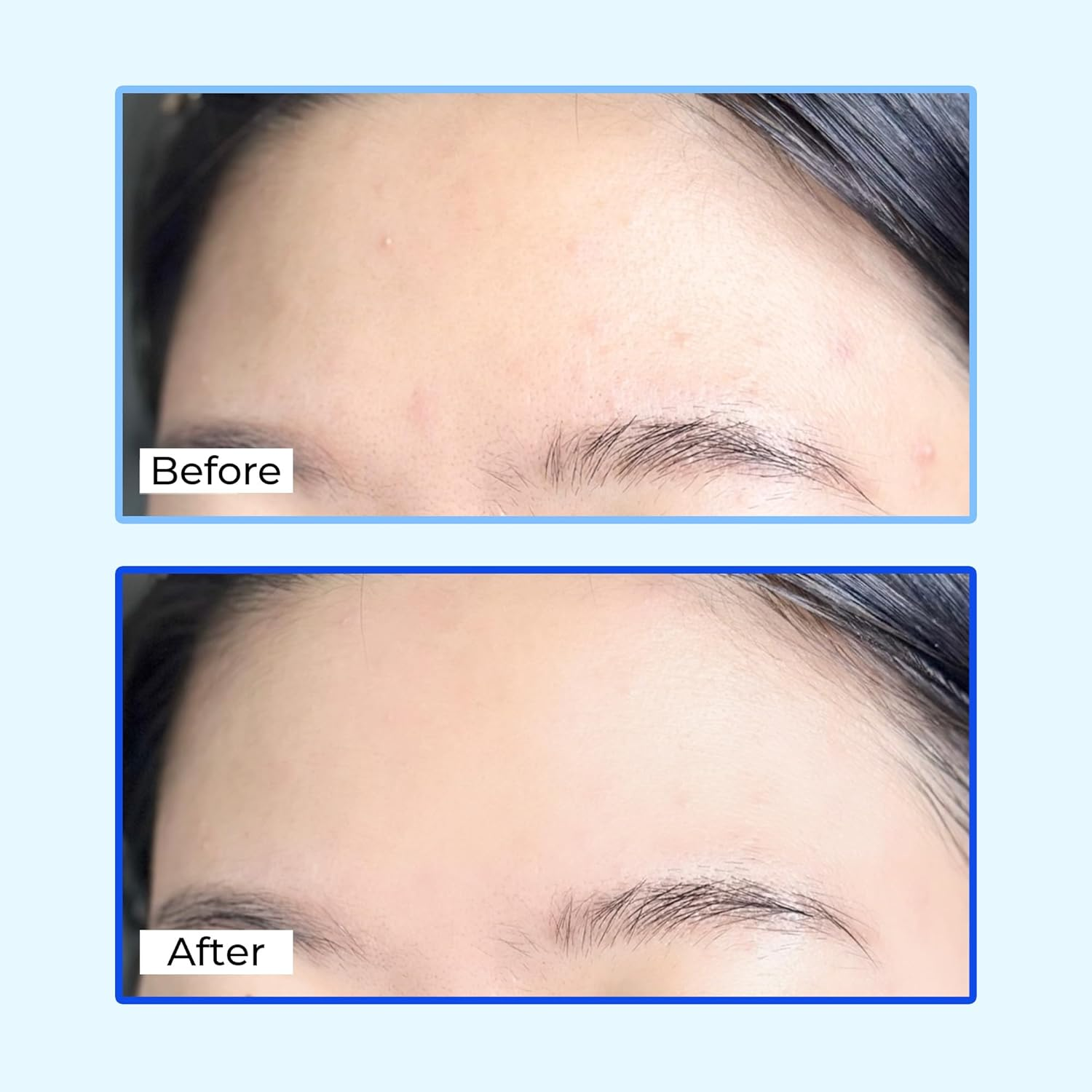 ALIVELAB Centella Dressing Powder &ndash; Acne Spot Treatment for Sensitive & Oily Skin &ndash; Fast Drying Blemish Healing Formula with Centella Asiatica for Redness Relief & Oil Control &ndash; 8Ml image number 3