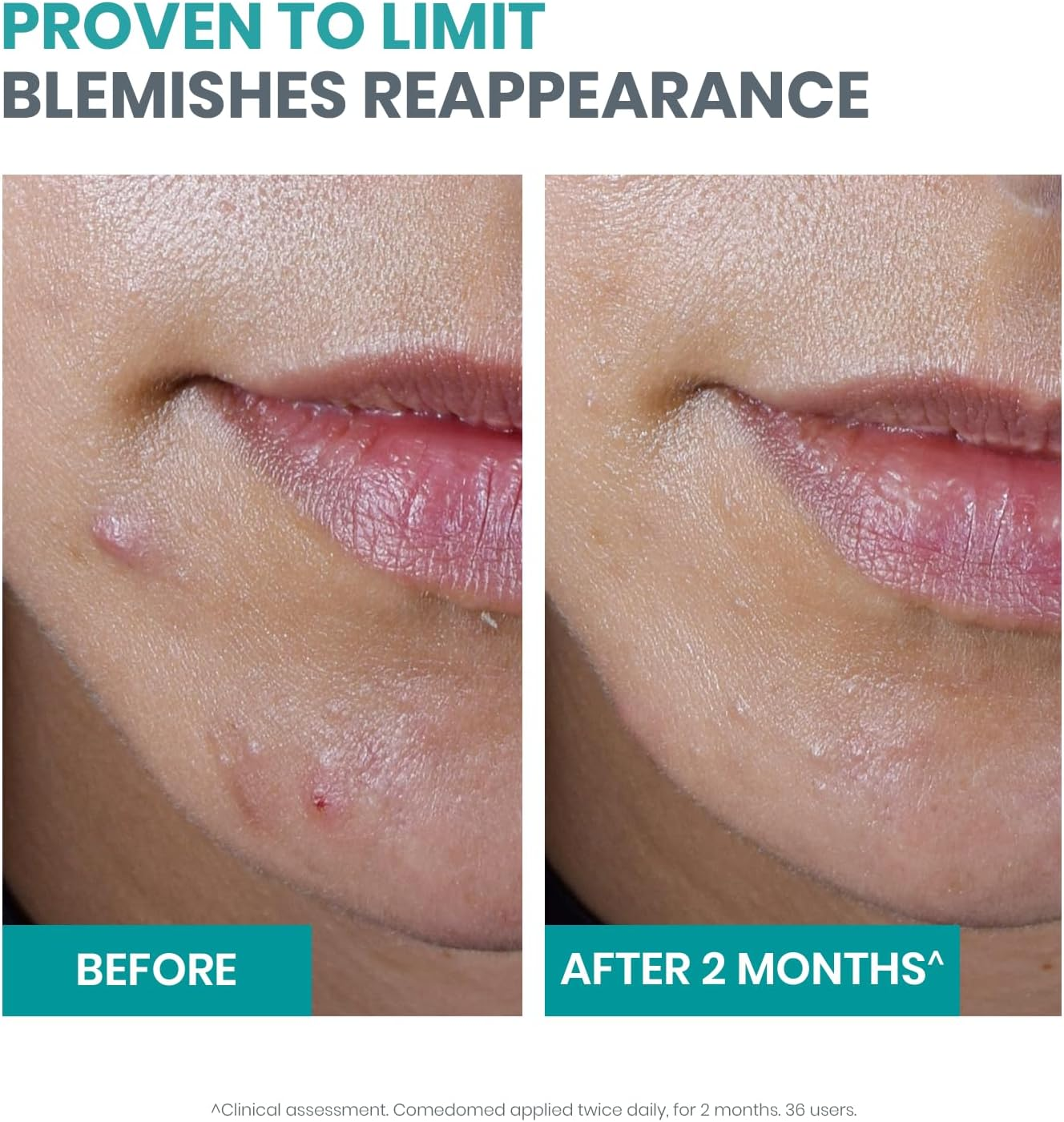 Eau Thermale Av&egrave;ne Cleanance Starter Kit - Cleanser and Moisturiser for Oily and Acne-Prone Skin image number 3