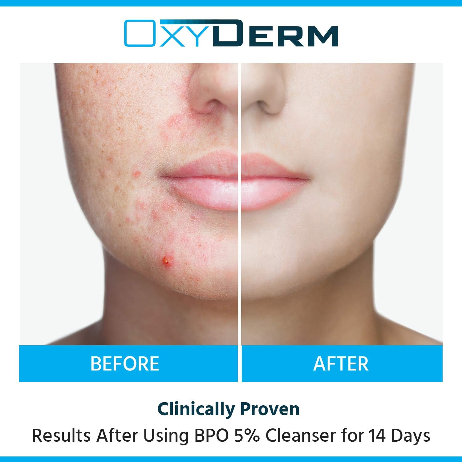 Benzoyl Peroxide 5% Acne Cleanser- Clinically Proven Wash to Fight Acne Blemishes on Contact. Eliminates Cystic Breakouts, Oily Skin, Clogged Pores, Blackhead & Whitehead Pimples for Face & Body. image number 2