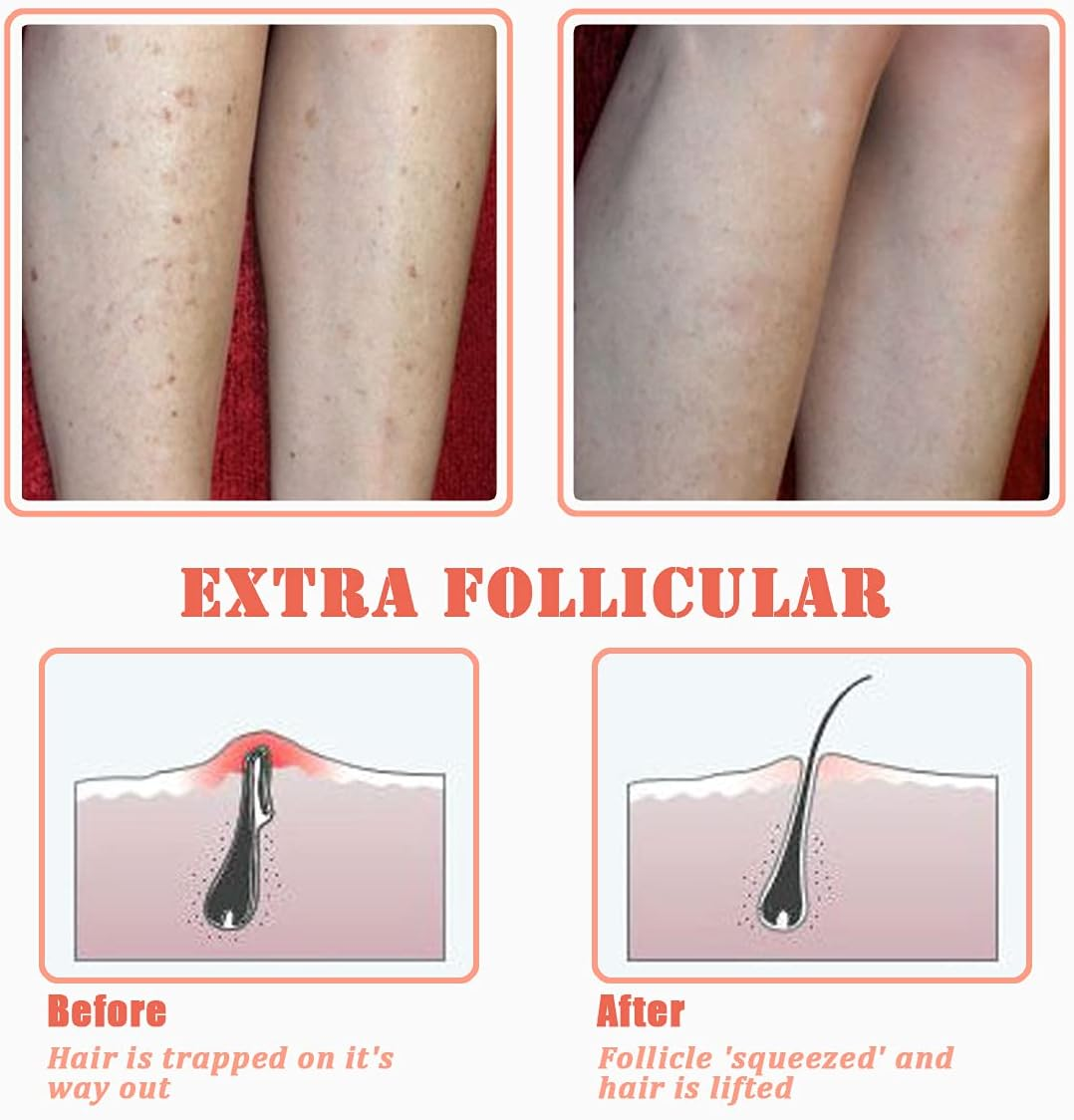 Tailaimei Exfoliating Brush for Ingrown Hair Treatment - to Treat and Prevent Bikini Bumps, Razor Bumps - Silky Smooth Skin Solution for Men and Women(Orange) - Blue image number 4