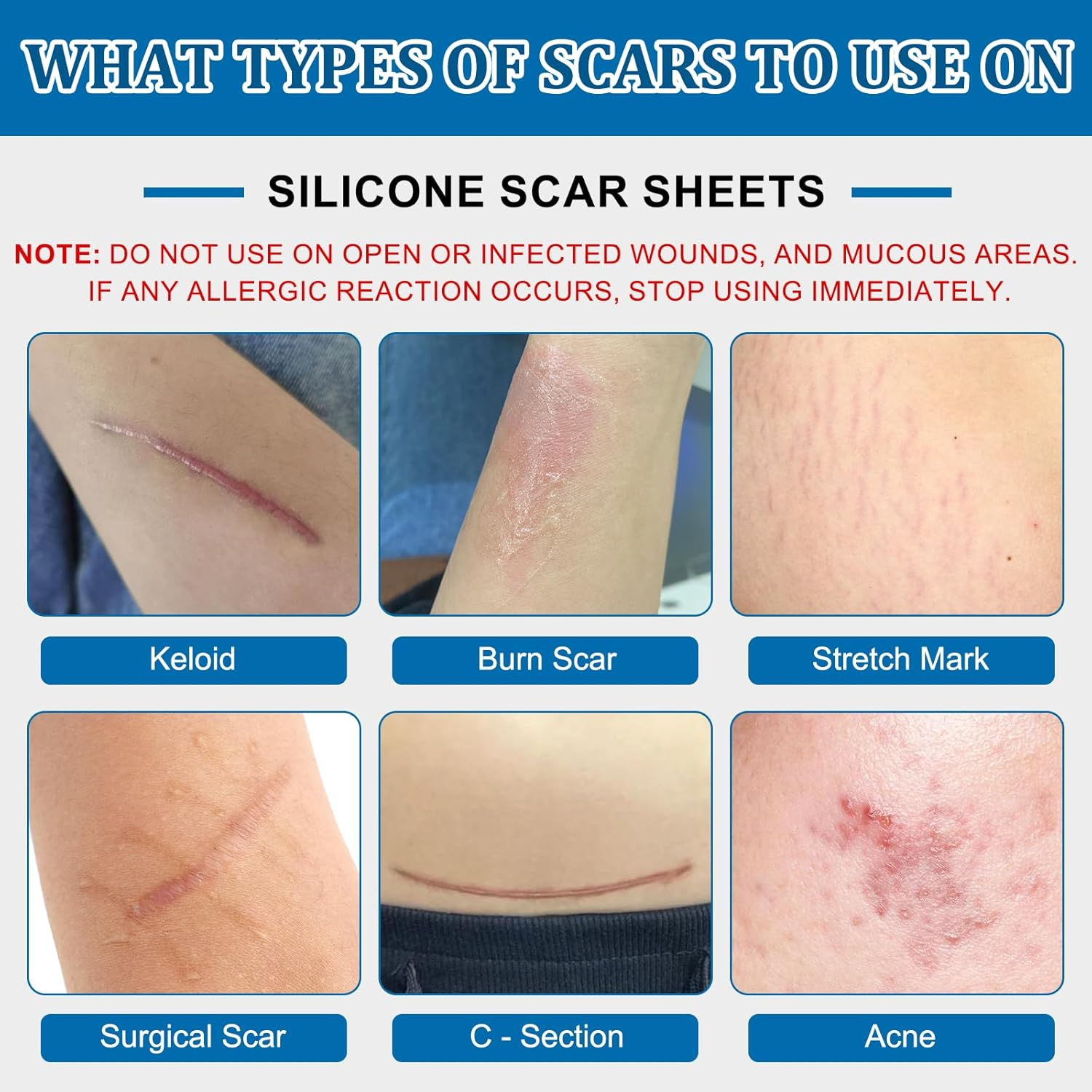 Silicone Scar Tape(3M - 1.6'' X 120''Roll) - Scar Removal Soft Silicone Scar Sheets Strips- Medical Grade, Reusable Gel Scar Tape for Keloid Surgery, C-Section, Acne and Burn