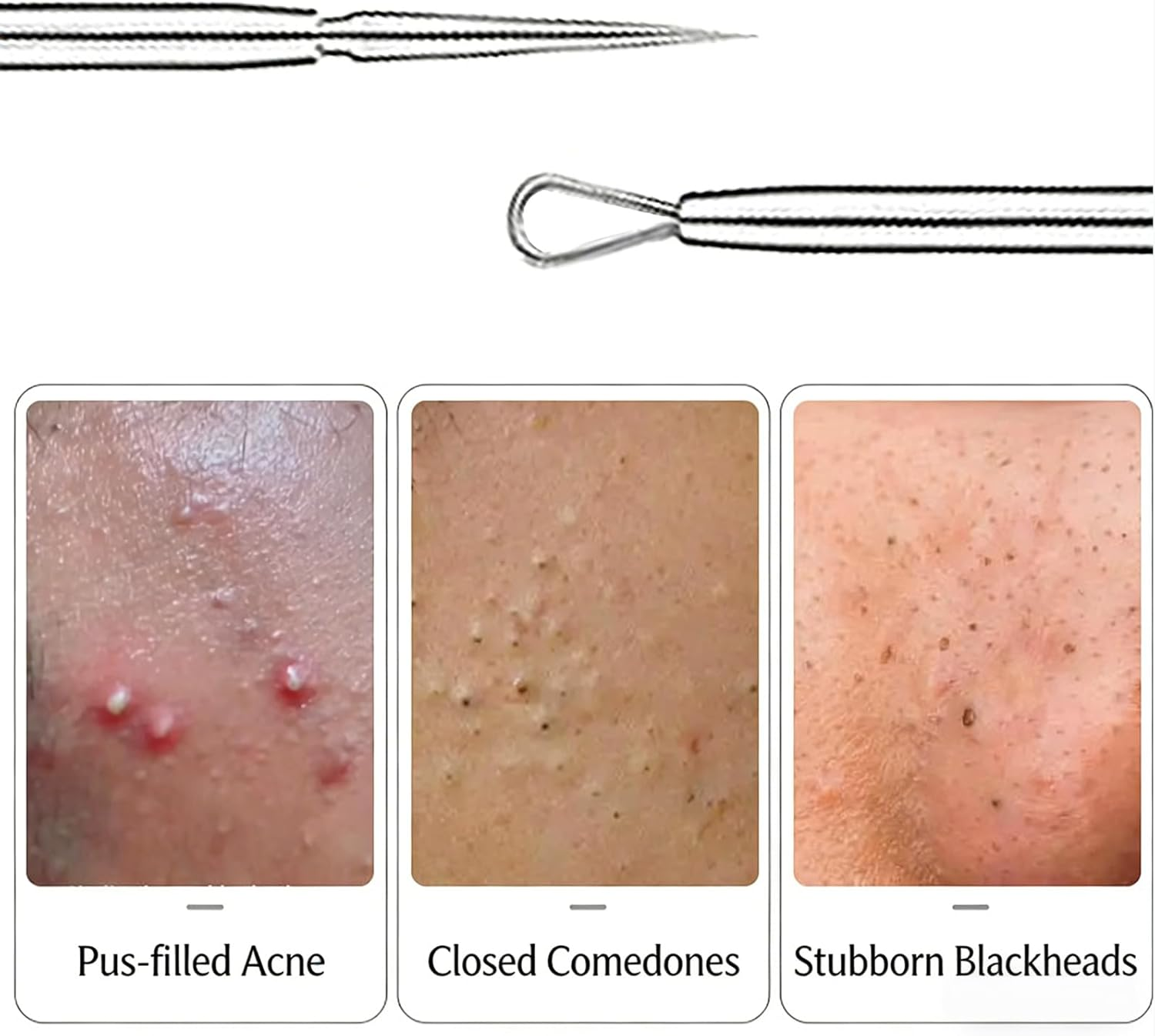 Yxvyxymyxxg Titanium Lancet Needle Pimple Popper Tool Professional Comedone and Blackhead Remover for Facial Milia Whitehead Extractor Skin Care Kit 2 Pieces with Storage Box image number 4