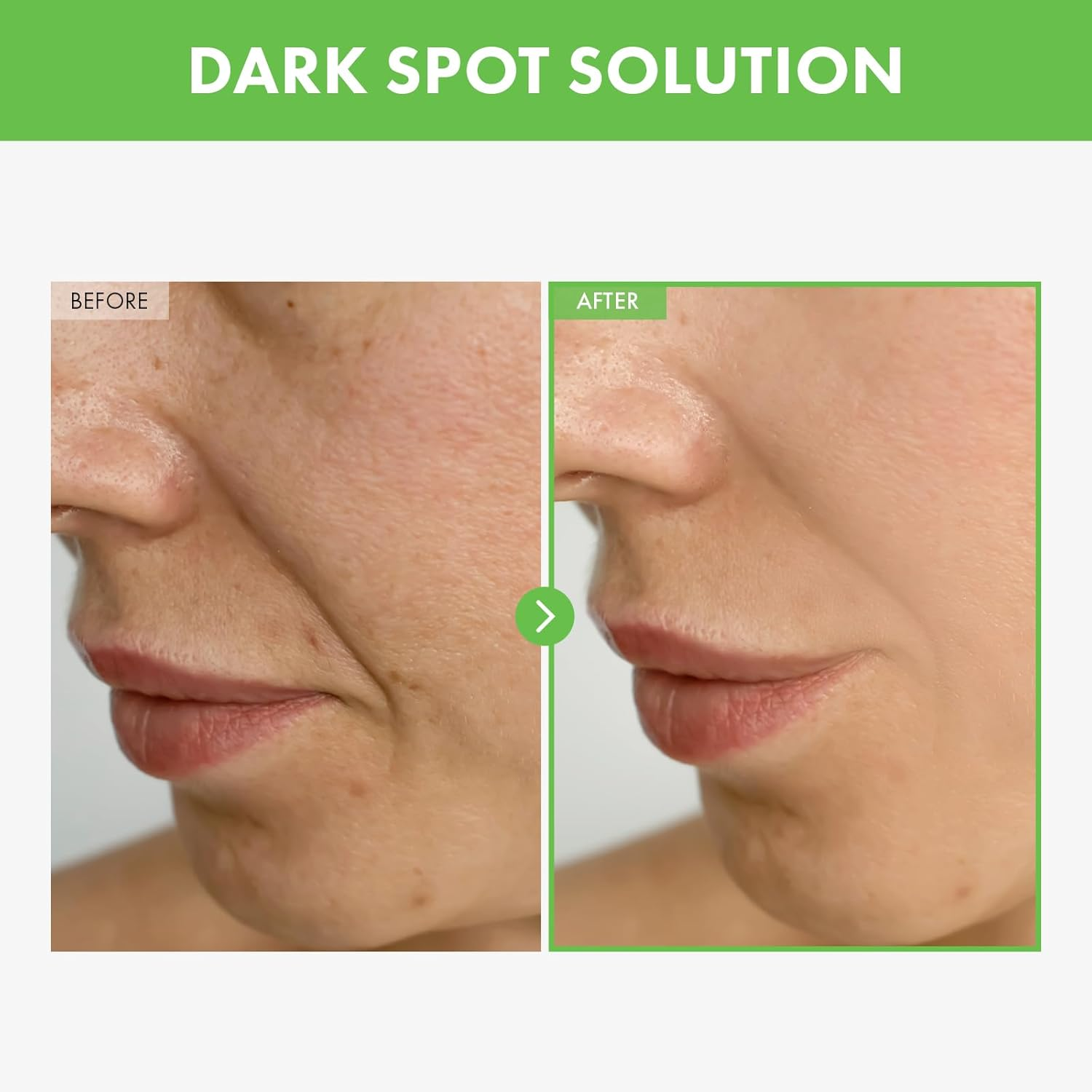 TOSOWOONG Kakadu Plum Blemish Cream, Dark Spot Remover for Face Cream, Kakadu Plum 600,000Ppm, Niacinamide, Adenosine, Betaine, Dark Spot Corrector, Vitamin C, Korean Skin Care, 50G, 1.76 Oz. image number 1