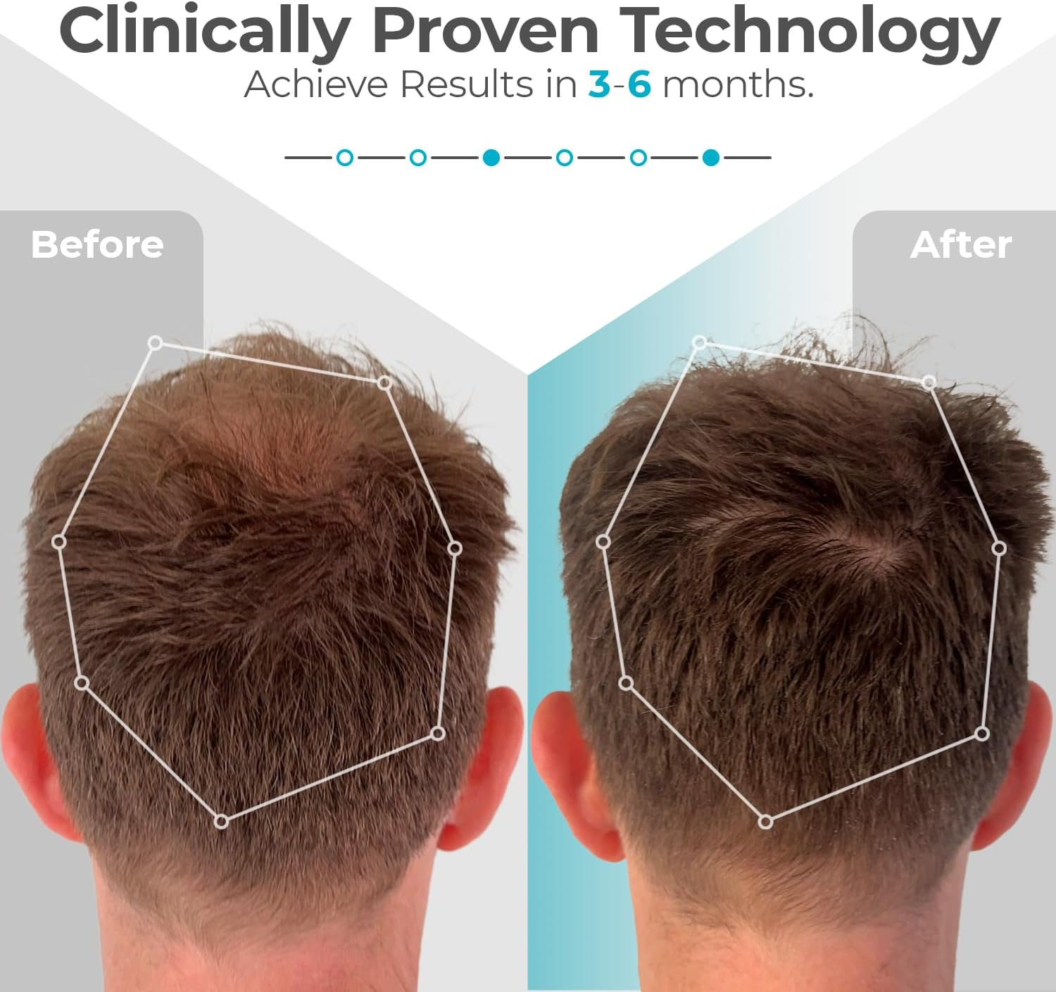 Capillus plus S1 | Hair Laser Growth Cap FDA Cleared to Regrow Fuller Thicker Hair in Men and Women Laser Hair Growth Cap Ideal for Thinning Hair and Alopecia Treatment image number 5