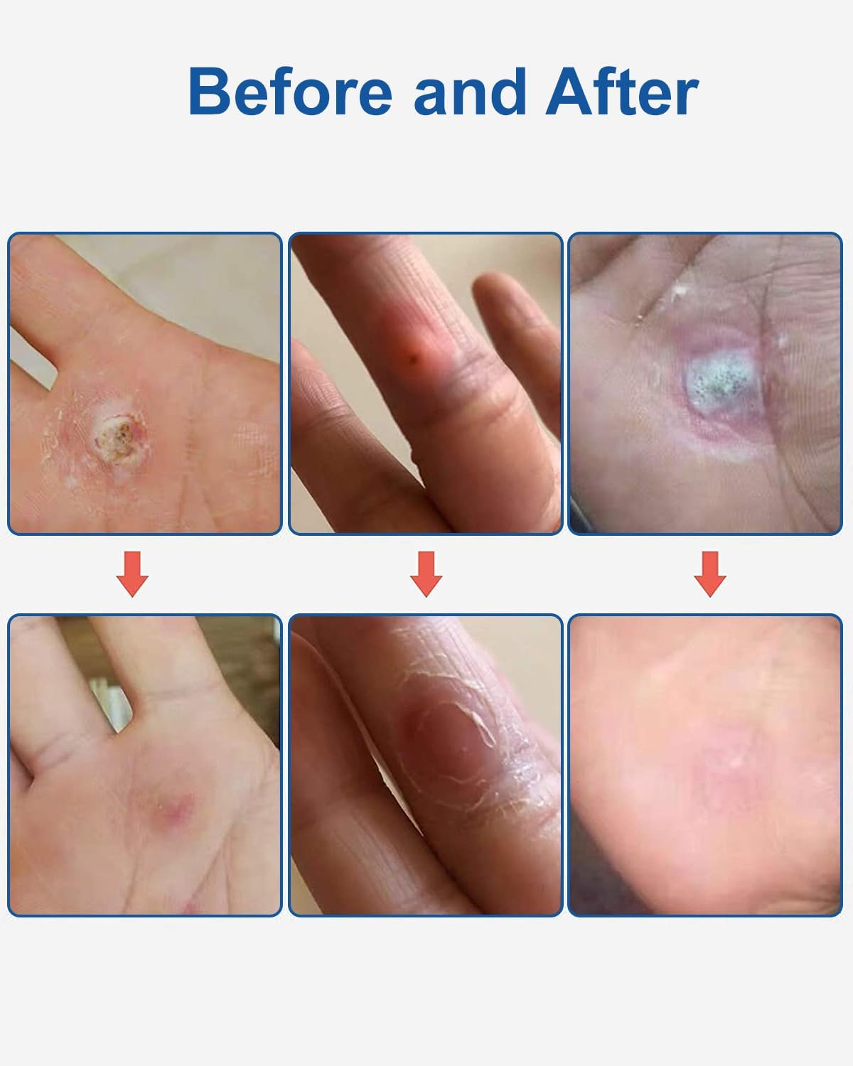 MYMULIKE 48Pcs Corn Removers for Toes & Feet, Tackle Tough Corns with Ease, 0.4" Diameter Large Size, Experience Quick Recover with Powerful, Easy-To-Use Corn Removal image number 4