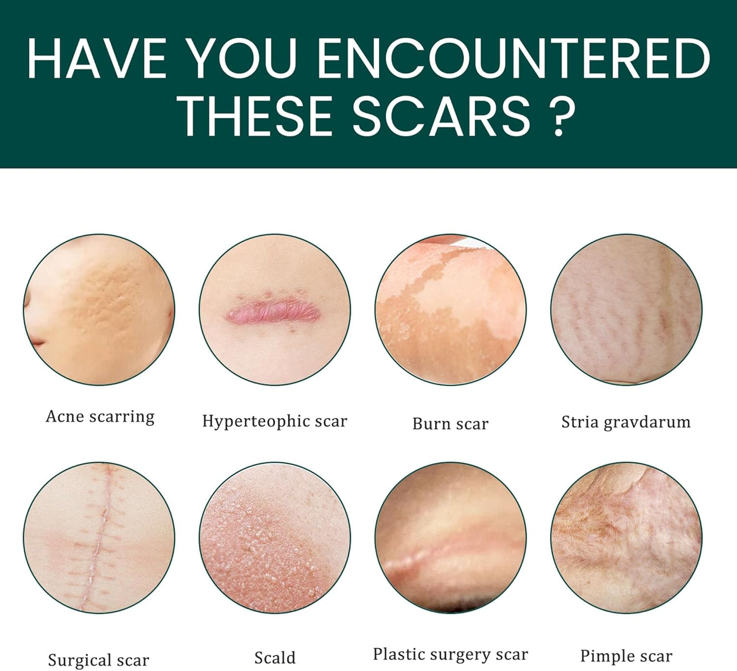 Silicone Scar Tape, Soft Silicone Scar Tape Painless Silicone Tape Roll for Surgical Keloid and Acne Scars (4 * 150Cm) image number 6