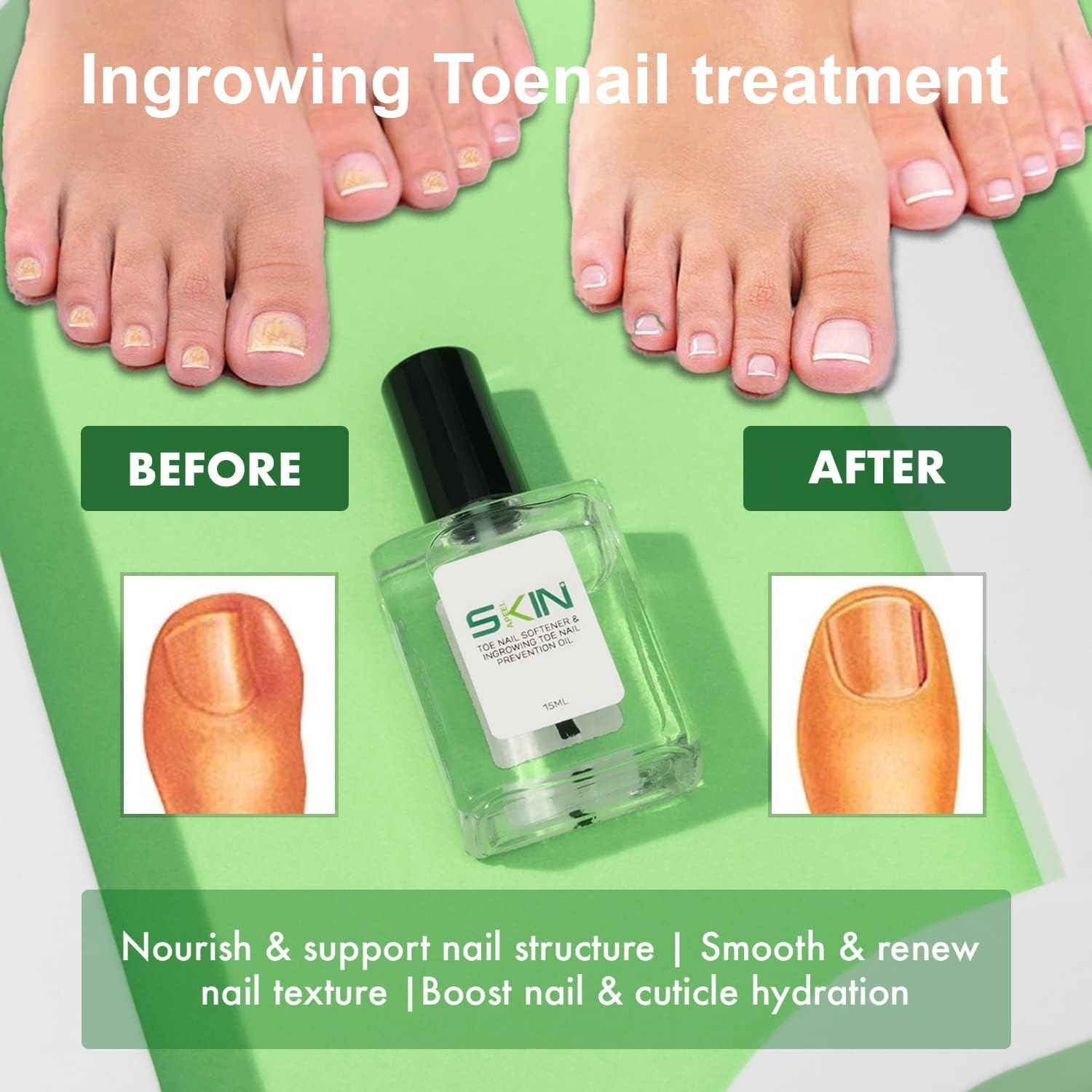 Skinapeel Toe Nail Softener & Ingrowing Toenail Prevention Oil 15Ml - Manicure Nourisher Cuticle Revitalizer Natural Treatment image number 2