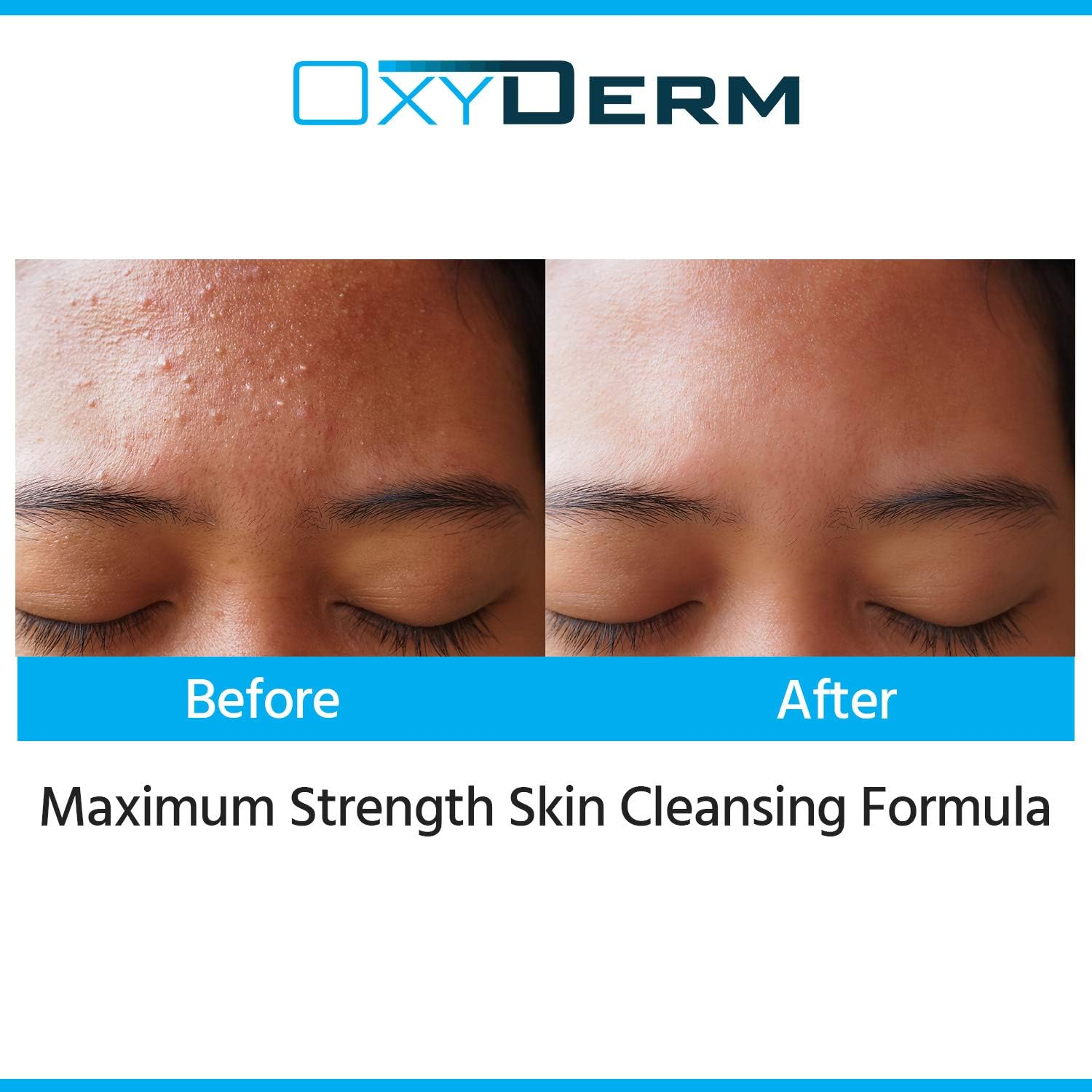 Benzoyl Peroxide 5% Acne Cleanser- Clinically Proven Wash to Fight Acne Blemishes on Contact. Eliminates Cystic Breakouts, Oily Skin, Clogged Pores, Blackhead & Whitehead Pimples for Face & Body. image number 5