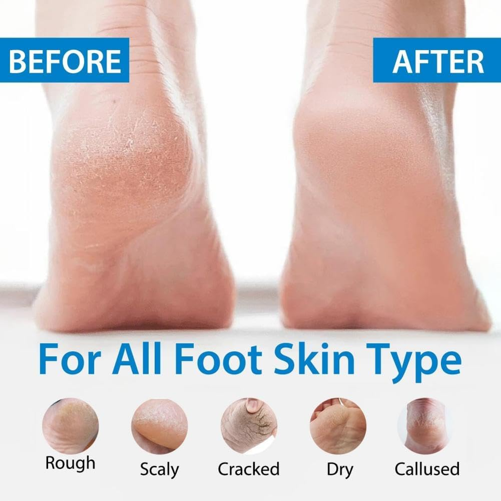 Urea Cream 40 Percent for Feet, Cream for Cracked Heel Feet Knees Hands Elbows for Dry Cracked, Moisturizer for Skin Care image number 3