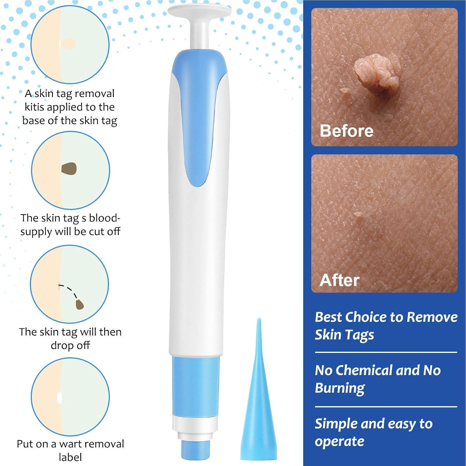 Skin Tag Remover Tools, Wart Remover Pen, Skin Tags Device for Small/Large Tags(4-9Mm), with Removes Cone-Shaped, Cleansing Pads, Patches, Instruction Manual image number 3