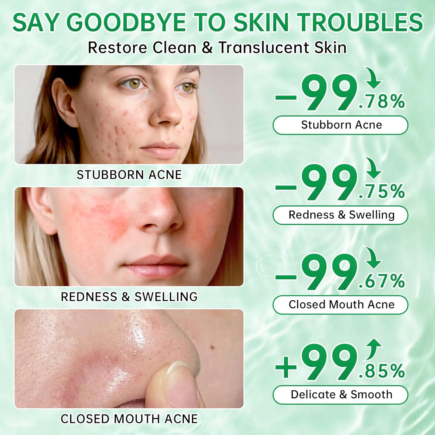 Azelaic Acid Boost Cream, 10% Azelaic Acid Booster Cream Gel for for Acne and Blemishes with Salicylic Acid, Balances Excess Sebum, Purifies Skin & Improves Skin Tone for All Skin Types, 30Ml image number 6