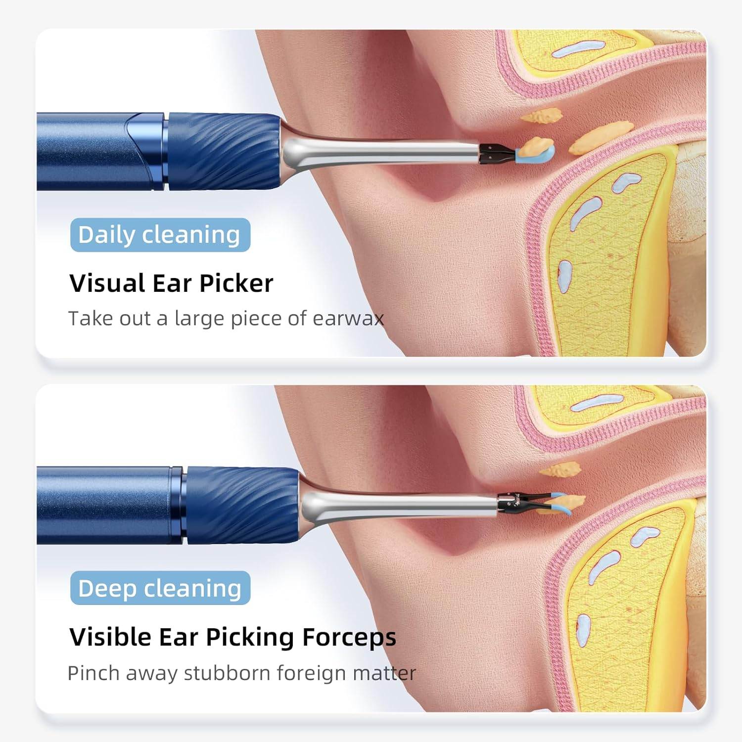 Ear Wax Removal with Tweezers - 1080P HD Ear Cleaner Ear Camera Otoscope, Omni-Direction Ear Pick Tweezer, Real-Time Remote Video,Multi Earwax Cleaning Replacement Kits image number 6