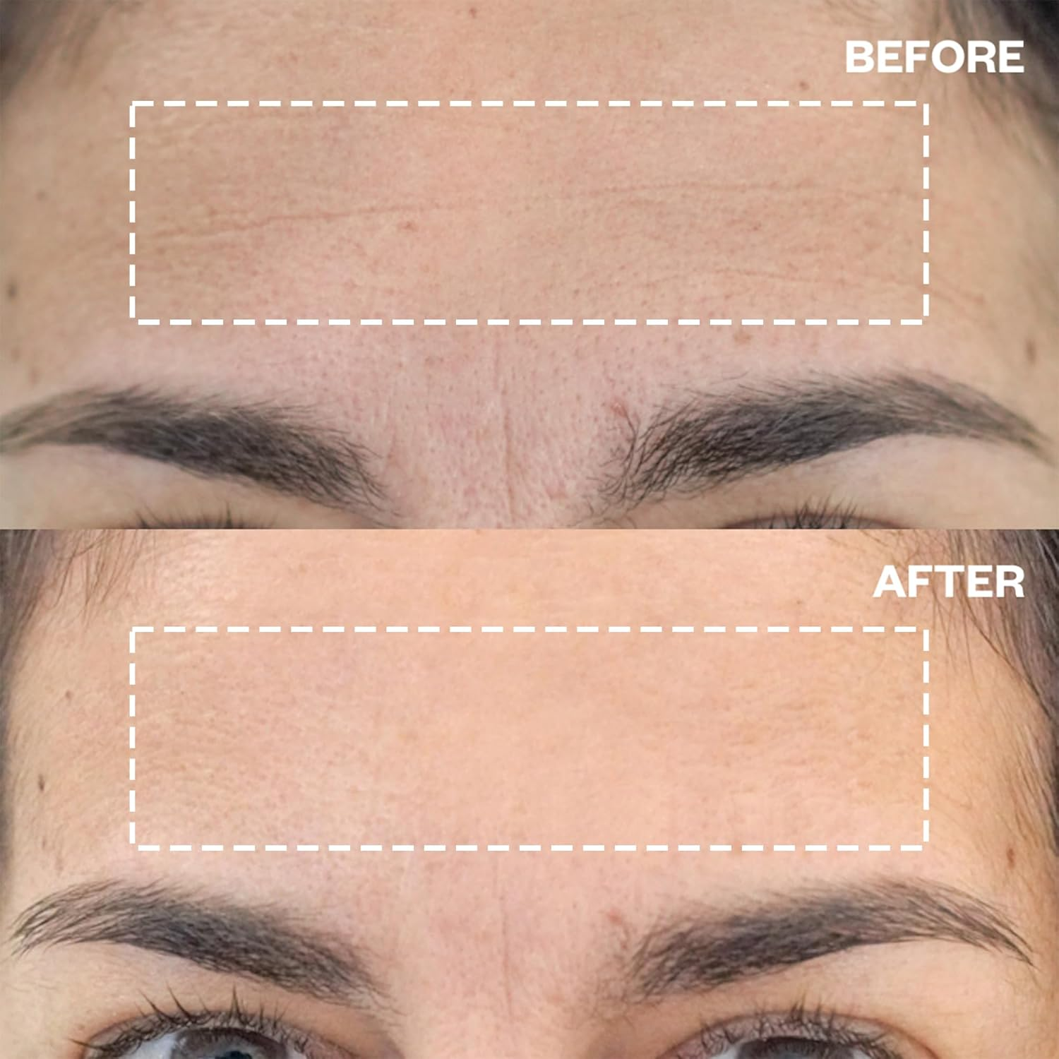 Wrinkles Schminkles Forehead & under Eye Wrinkle Set - Reusable Silicone Patches for Smoothing Facial Lines - Overnight Wrinkle Reduction (1 Pair)