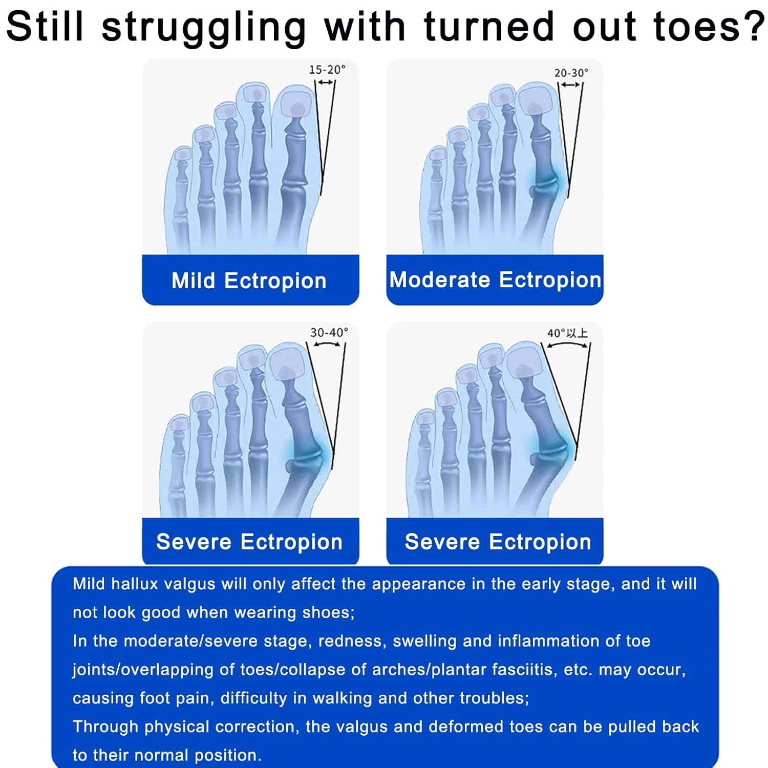 Bunion Corrector, Big Toe Bunion Corrector for Men Women, Adjustable Knob Bunion Support Splint with Anti-Slip Heel Strap for Big Toe Bunion Relief (Color : Gray Black Buckle) image number 2