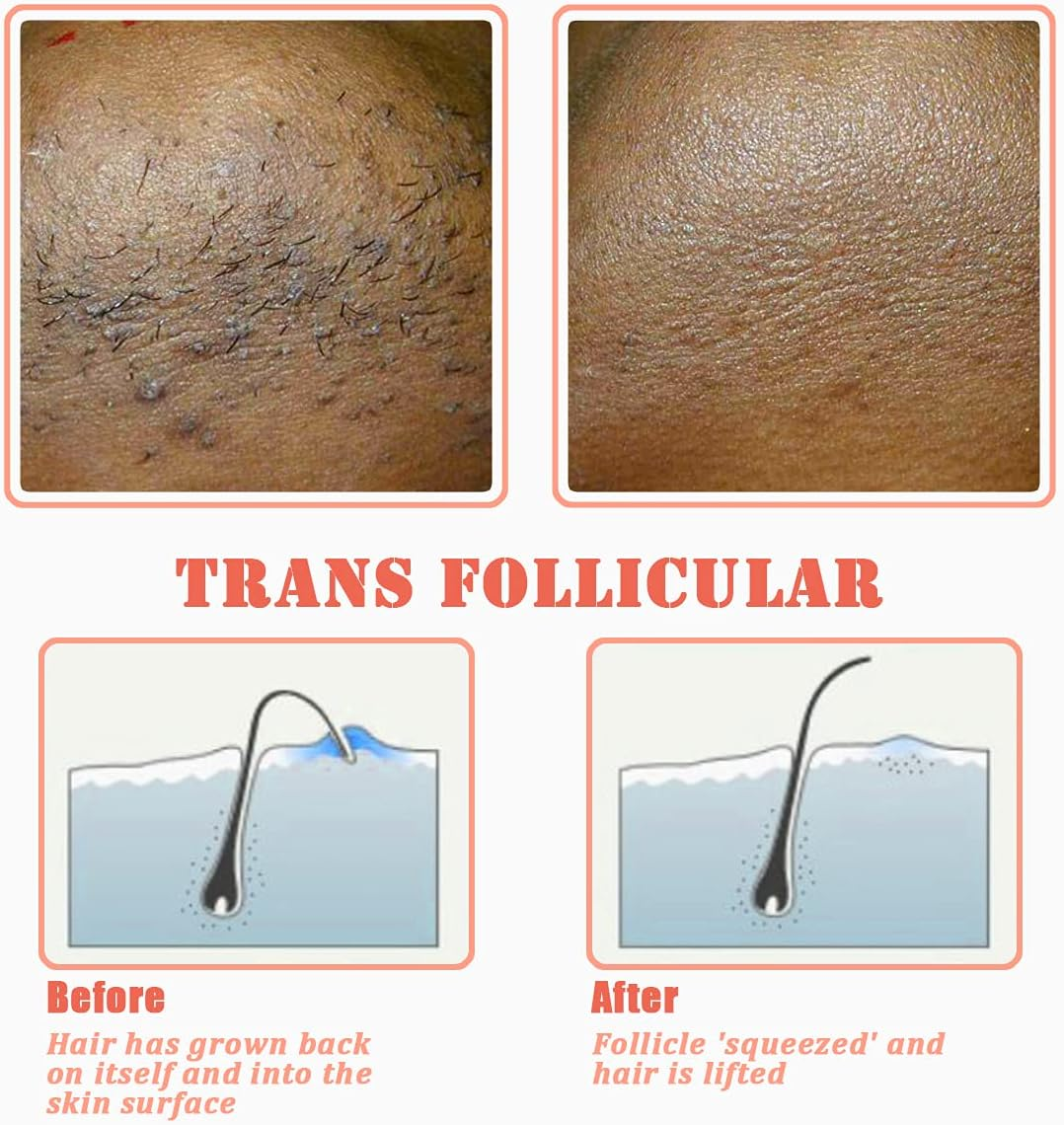 Tailaimei Exfoliating Brush for Ingrown Hair Treatment - to Treat and Prevent Bikini Bumps, Razor Bumps - Silky Smooth Skin Solution for Men and Women(Orange) - Blue image number 6