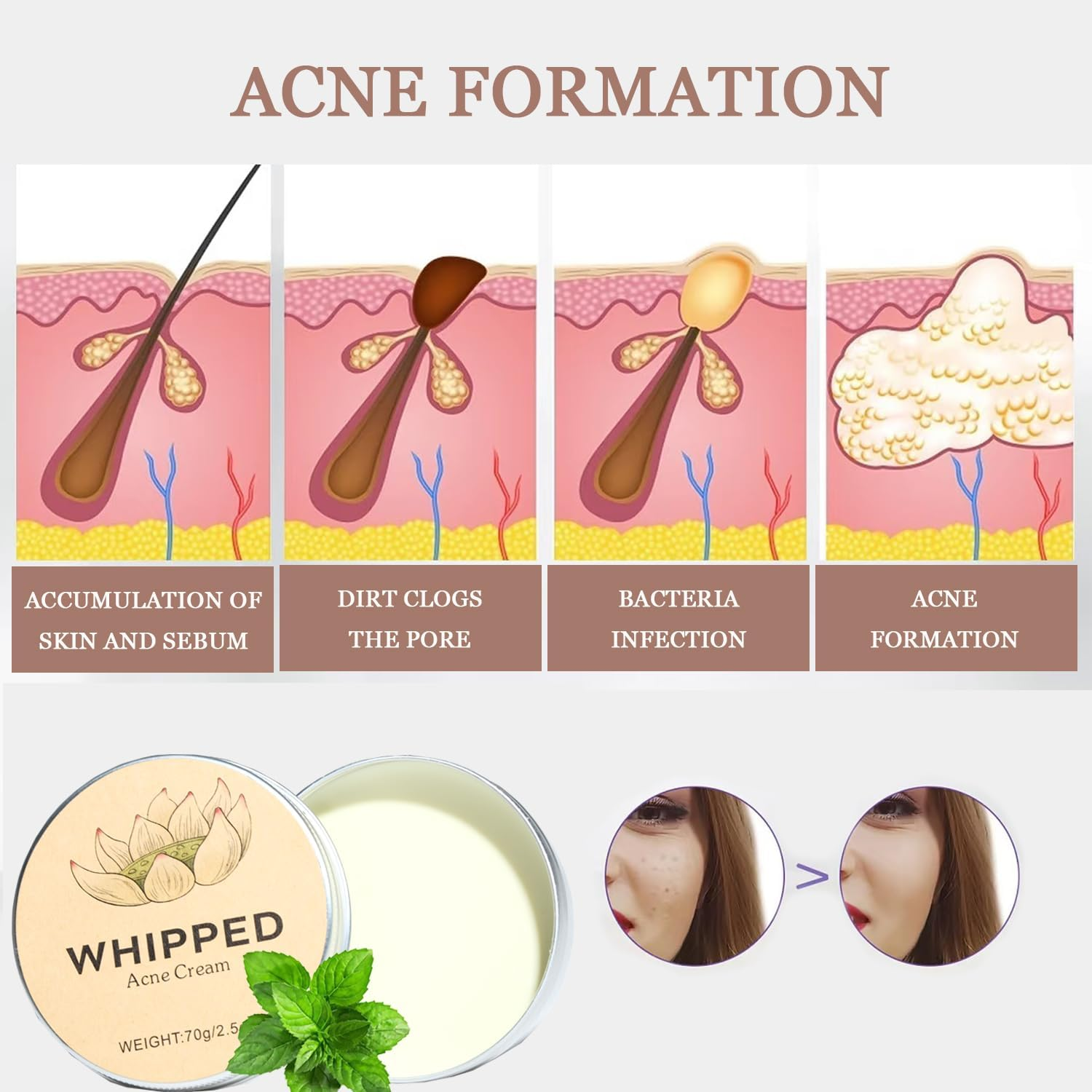 Norse Organics Acne, Norse Organic Acne and Redness Relief Balm, Norse Organics Acne & Redness Killer, Acne Remove Skin Care Set, Face Balm for Teens and Adults(70G/2.5Oz)