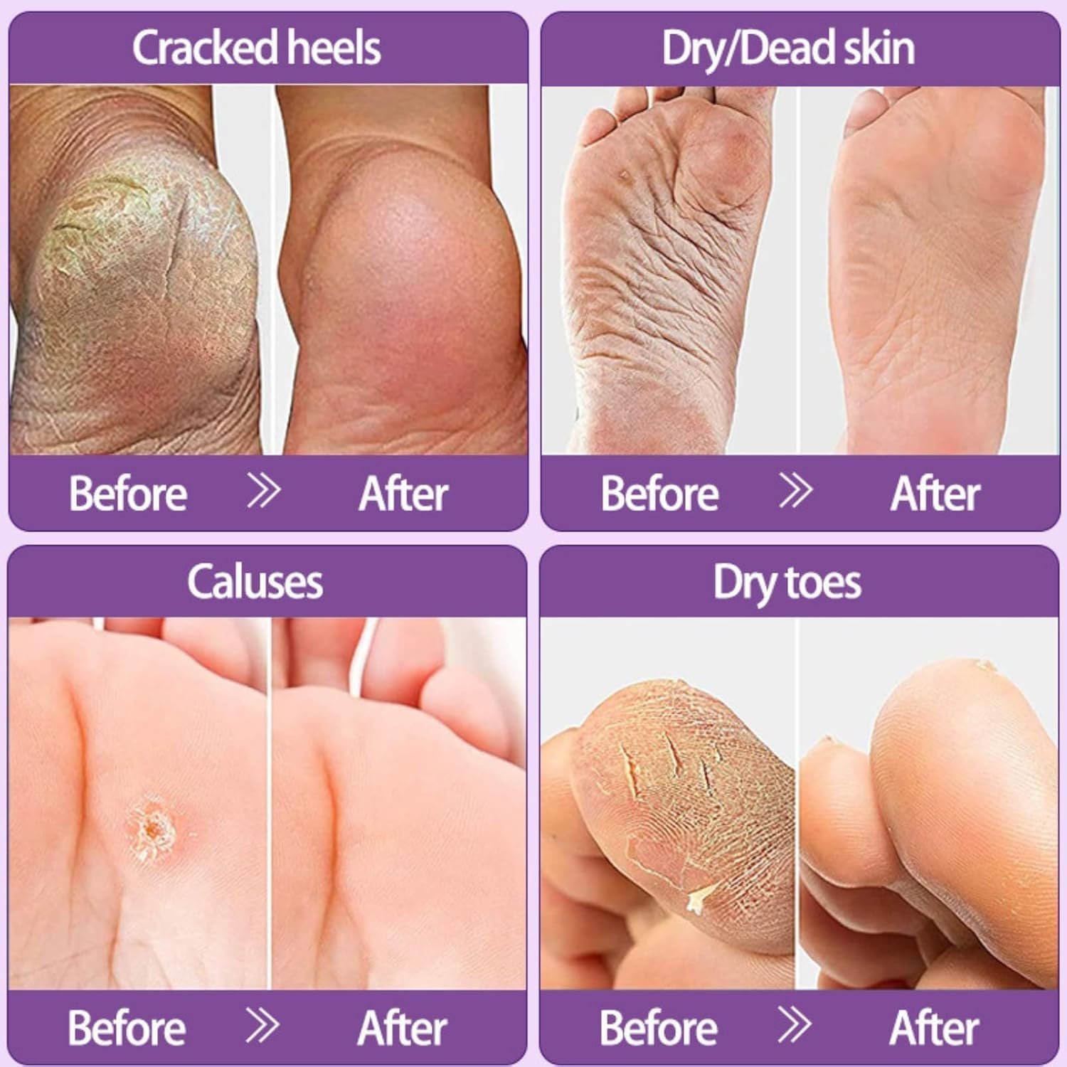 Foot Peel Mask 2 Pack, Exfoliator Peel off Calluses, Exfoliating Foot Care,Foot Exfoliator Repair Dry Cracked Feet,Peeling Away Dead Skin, Calluses, Dead Skin Callus Remover, Baby Soft Smooth Touch Feet-Men Women (Foot Masks) - Hand Masks image number 4