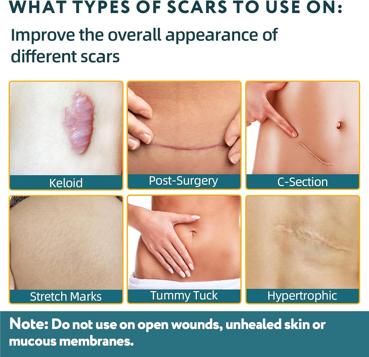 Silicone Scar Sheets, Silicone Scar Tape for Surgical Scars - 60" X 1.6" Roll - 1.5M, Medical Grade Reusable Effective Scar Removal for Keloid, C-Section, Tummy Tuck, and Acne