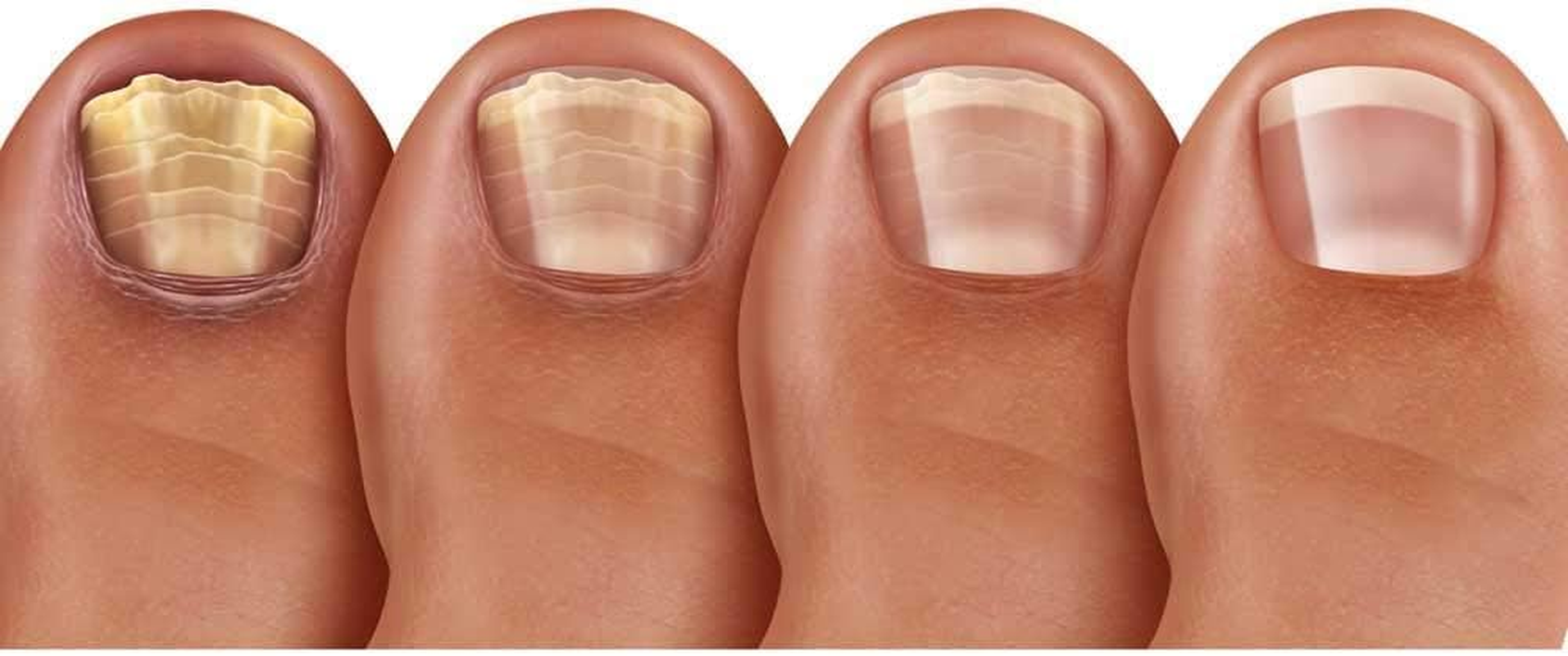 PRONAILPLUS FUNGAL Nail Solution 10Ml &ndash;TREATMENT for FUNGAL NAIL SOLUTIONS Pronail plus Treats Fungal Nail Infections Fast and Effectively