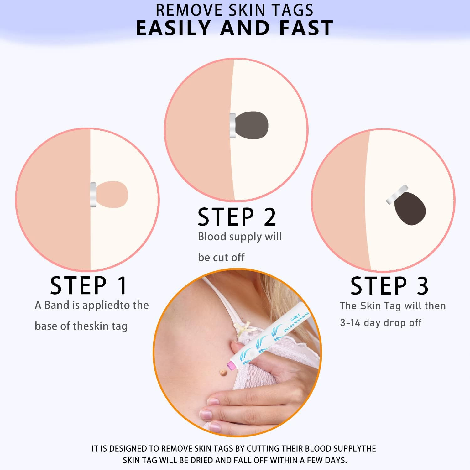 Auto Skin Tag Removal Pen - Remover 2 in 1 Standard and Micro 36Pcs Repair Patches Safe for Small to Large (2Mm to 8Mm) Sized Skin Tags for Most Body (Auto Blue) - Auto Blue image number 6