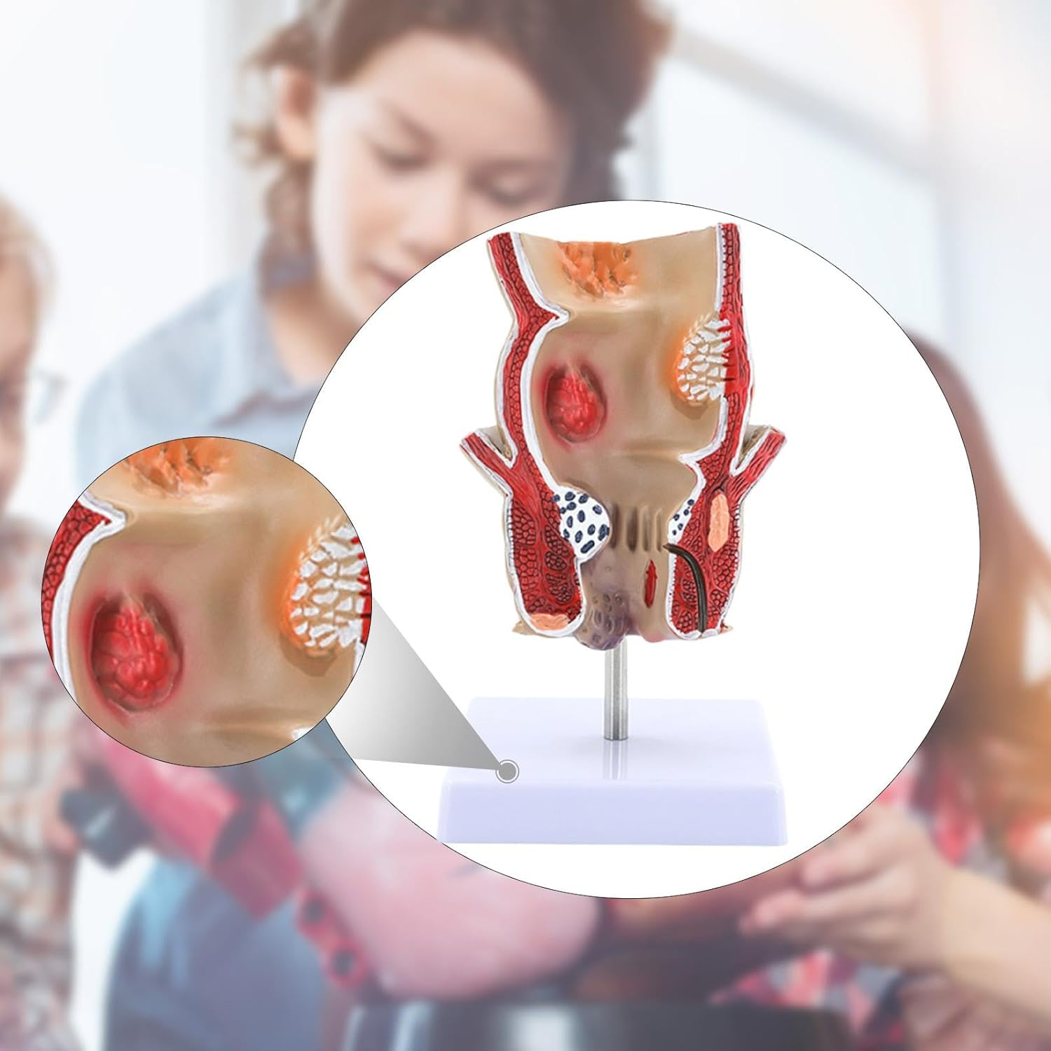 Eigell Human Pathology Rectal Model Educational Display Tool for Study School