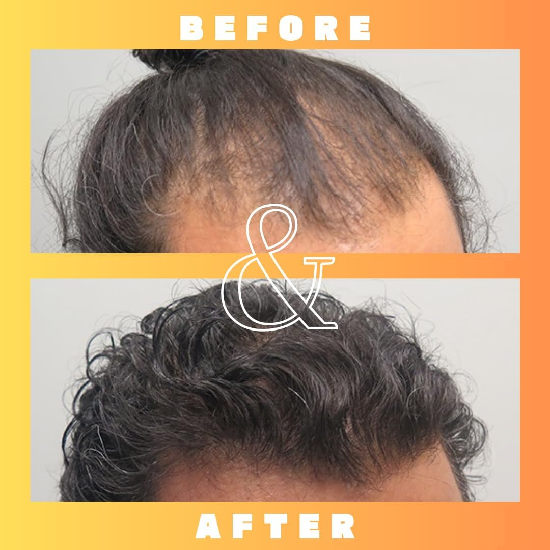 Mettle Mane - RU58841 5% Solution (50Mg/Ml) Hair Serum - 30Ml Bottle image number 4