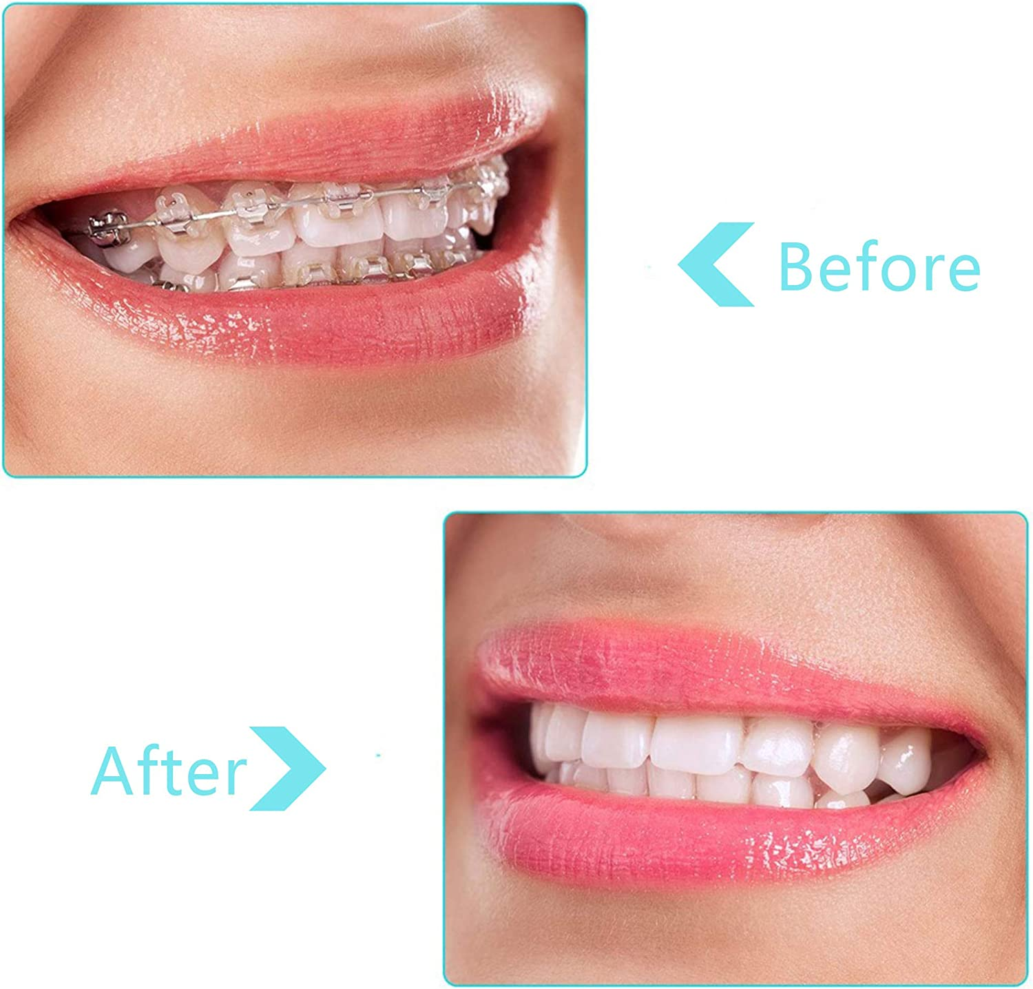 20 Pcs Aligner Tray Seaters Aligner Chewies Aligner Seater Chewies for Aligner Trays Chompers Aligner Trays 5 Colors image number 6