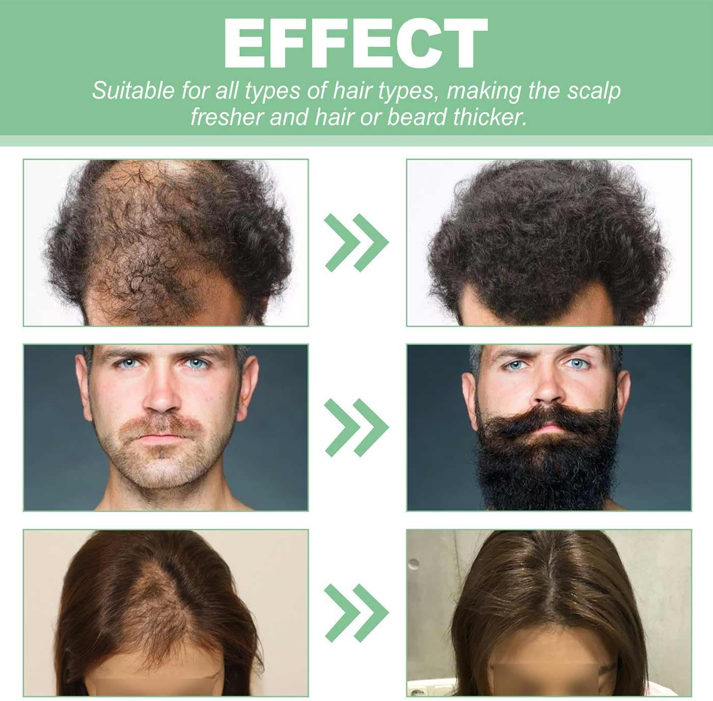 Renewhairx - Renew Hair X Roll-On Hair,Hair and Beard Regrowth,Roll-On Hair Growth Oil,Hair Growth Serum,Anti-Hair Loss Essential Oil,Hair and Beard Regrowth Roll on Serum for Women Men image number 2