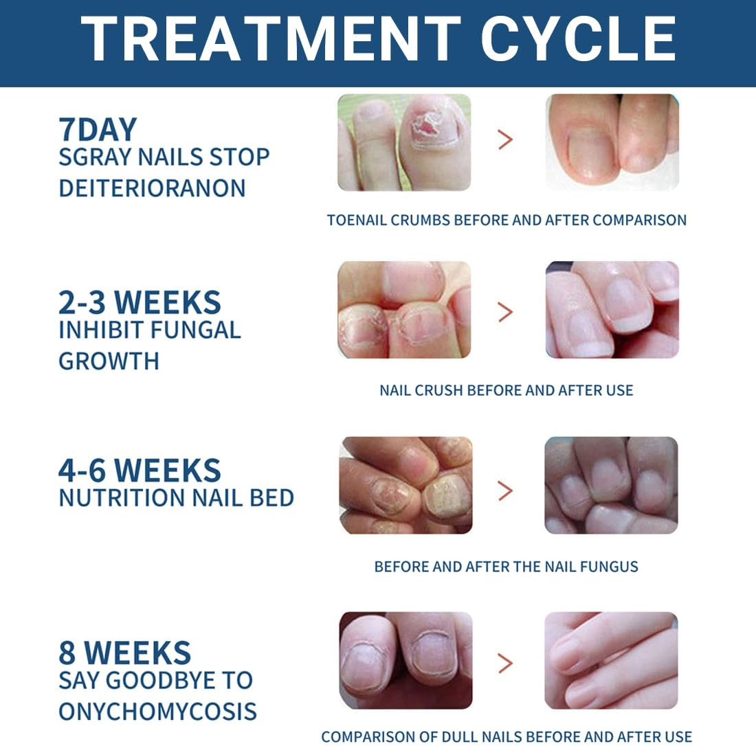 GXGM 32 Pieces Toenail Treatment, Nail Digging Repair Patches, Improve the Appearance of Discoloured Nails image number 5