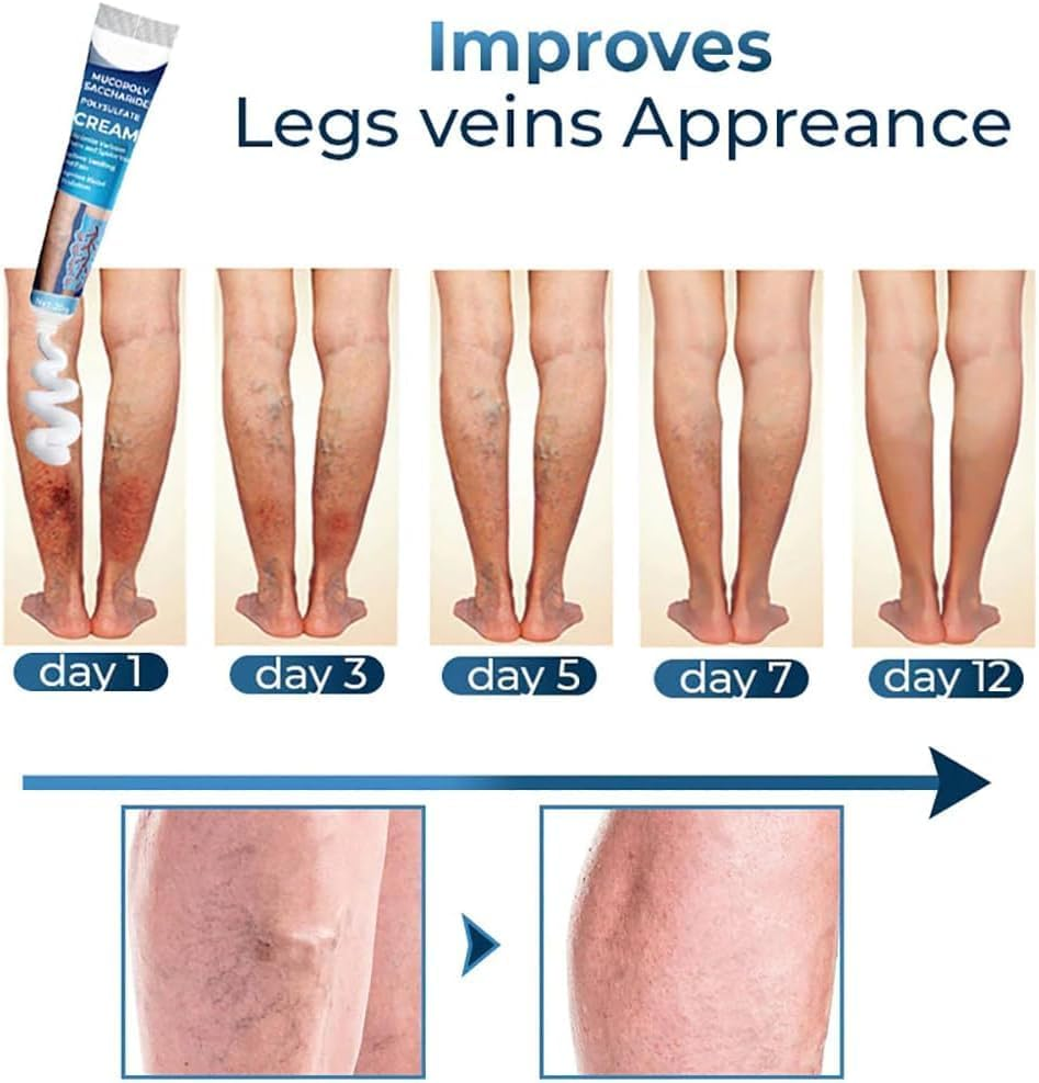 3Pcs GFOUK Mucopolysaccharide Polysulfate Cream,Varicose Veins Cream,Varicose Veins Treatment for Legs,Removal Spider Veins Improve Blood Circulation