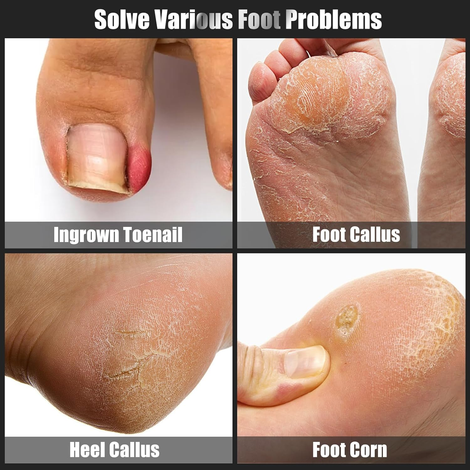 7-Piece Ingrown Toenail Treatment Set, Professional Stainless Steel Ingrown Toenail Removal Kit, Calloused Feet Remover Tool, Manicure Treatment Pedicure Tools for Feet (Under-Nail Clean + Foot Care) image number 5