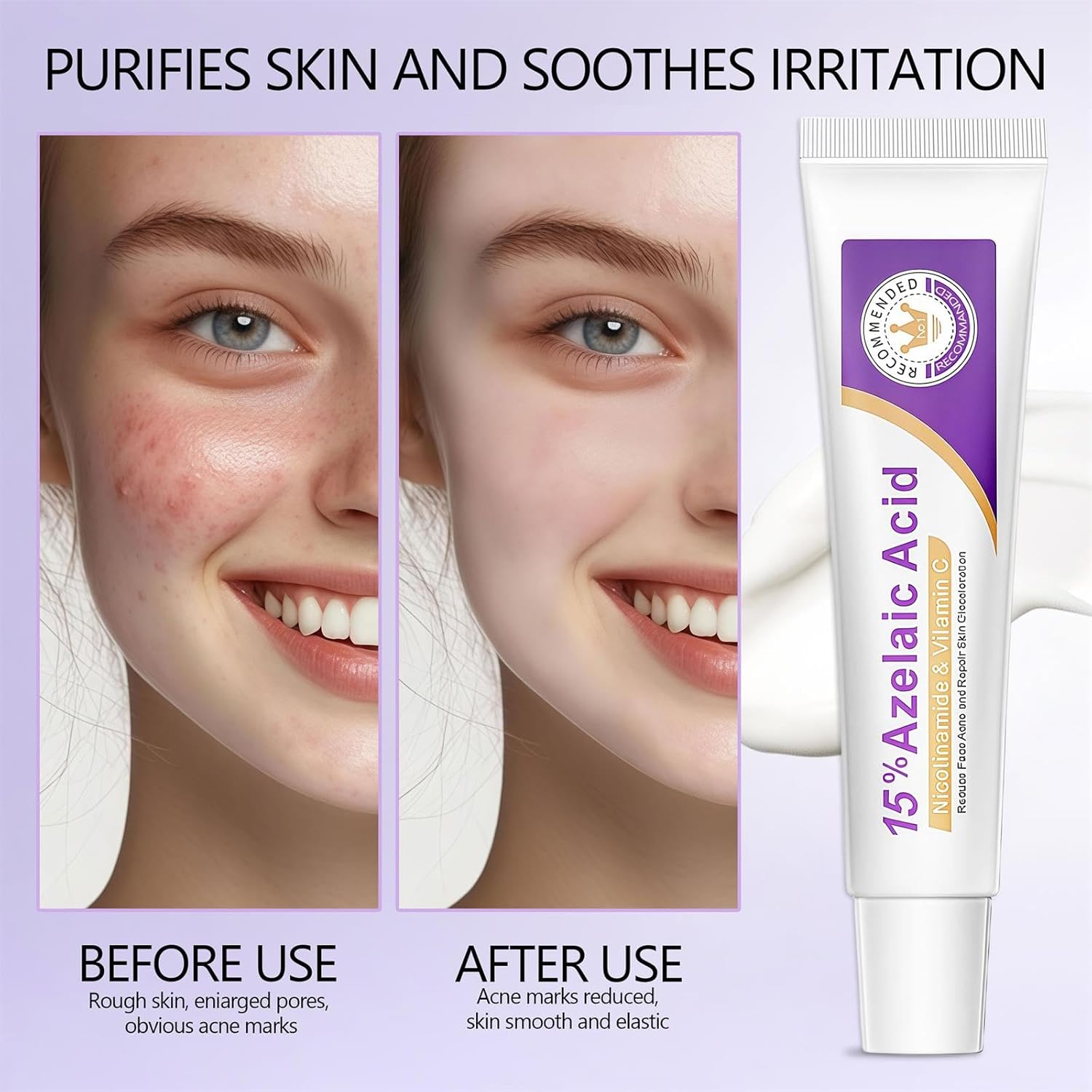 Ai-Uchoice Azelaic Acid 10% Cream for Face Body, 0.7 OZ Azelaic Acid Acne Cream Gel with Salicylic Acid for Skin Balancing Nourishing for Sensitive Skin Care & Daily Routines (Ai-Uchoice, 15% Azelaic Acid Cream)