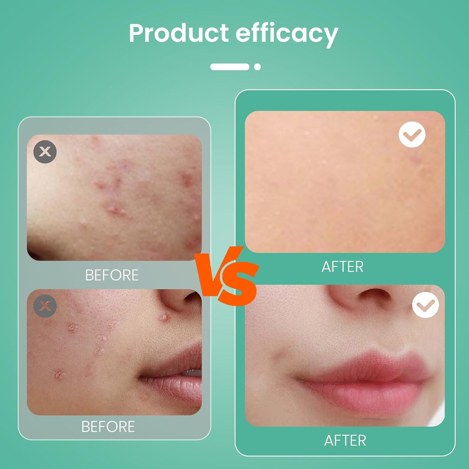 Nozibye 443Pcs Acne Patch Translucent Hydrocolloid Pimple Patches for Full-Face Blemish Care-Gently Absorbs Gunk- Strong Adhesion-Shields Skin-Ultra-Thin & Cozy-Day & Night Use - Sensitive Skin Safe - Premium Hydrocolloid - 5 Size Pack image number 3