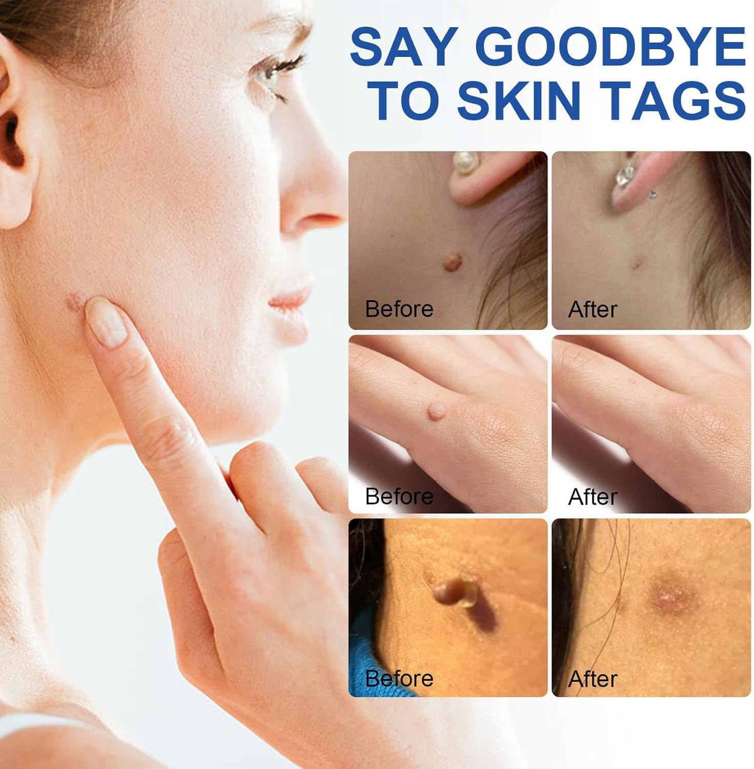 Skin Tag Remover Tools, Wart Remover Pen, Skin Tags Device for Small/Large Tags(4-9Mm), with Removes Cone-Shaped, Cleansing Pads, Patches, Instruction Manual image number 1