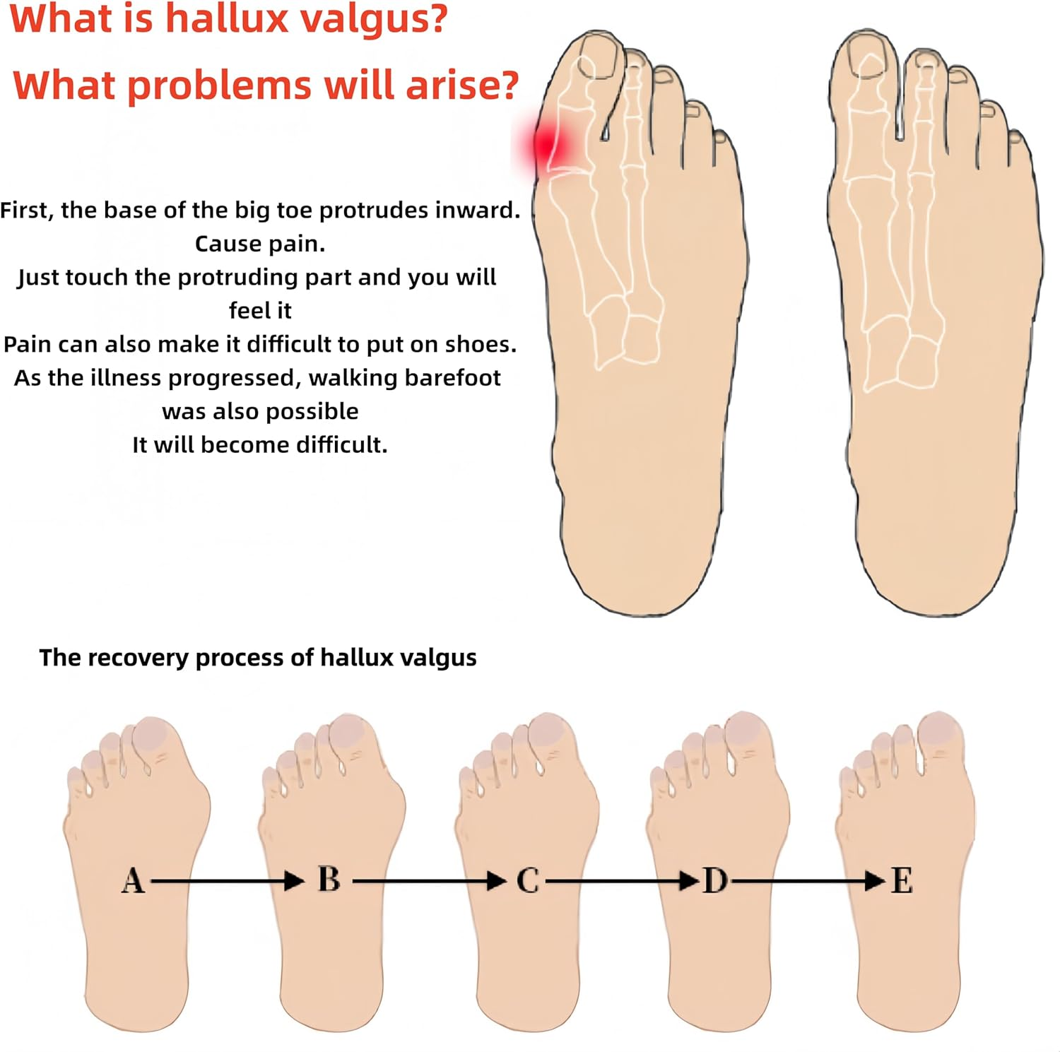 Linjhokbs 2 Pairs Toe Spacers，Correct Bunions and Restore Toes to Their Original Shape/Bunion Corrector Toe Spacer Toe Straightener Toe Stretcher Big Toe Correctors for Women and Men，Skin-Color image number 1